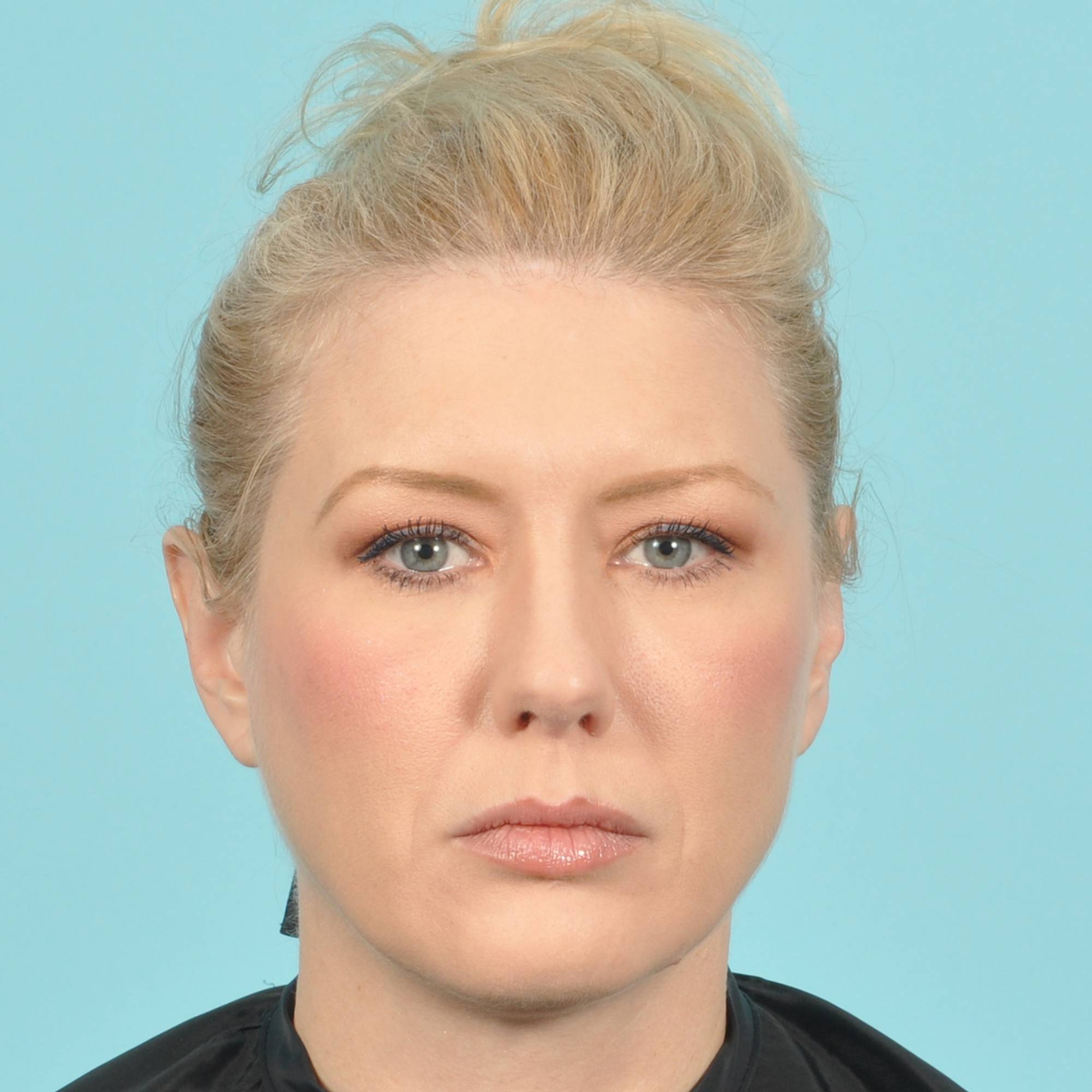 Blepharoplasty Before & After Image