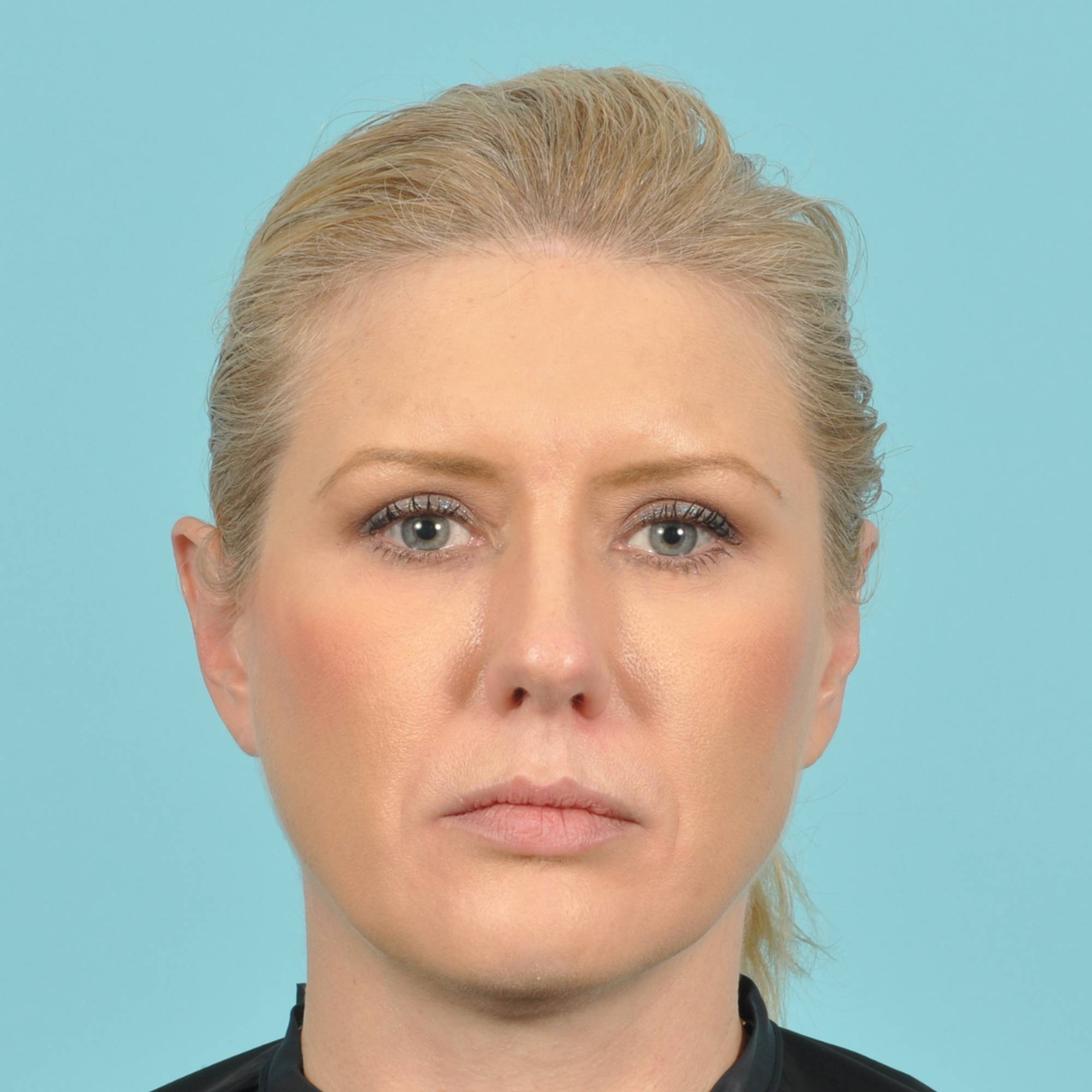 Blepharoplasty Before & After Image