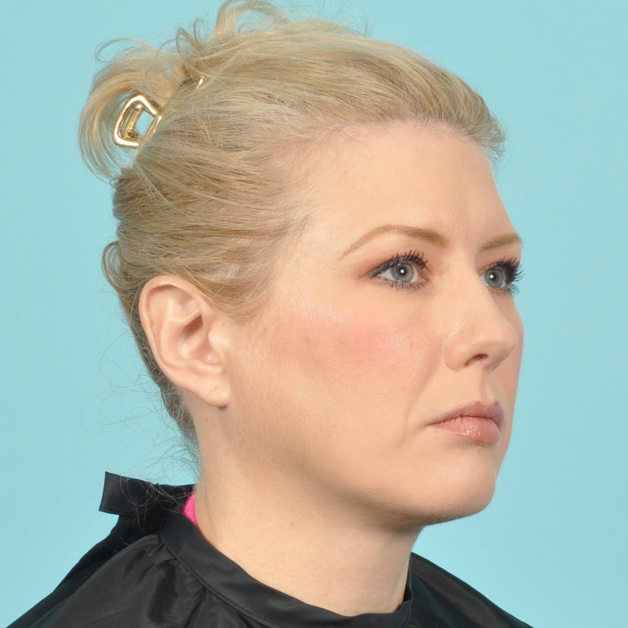 Blepharoplasty Before & After Image