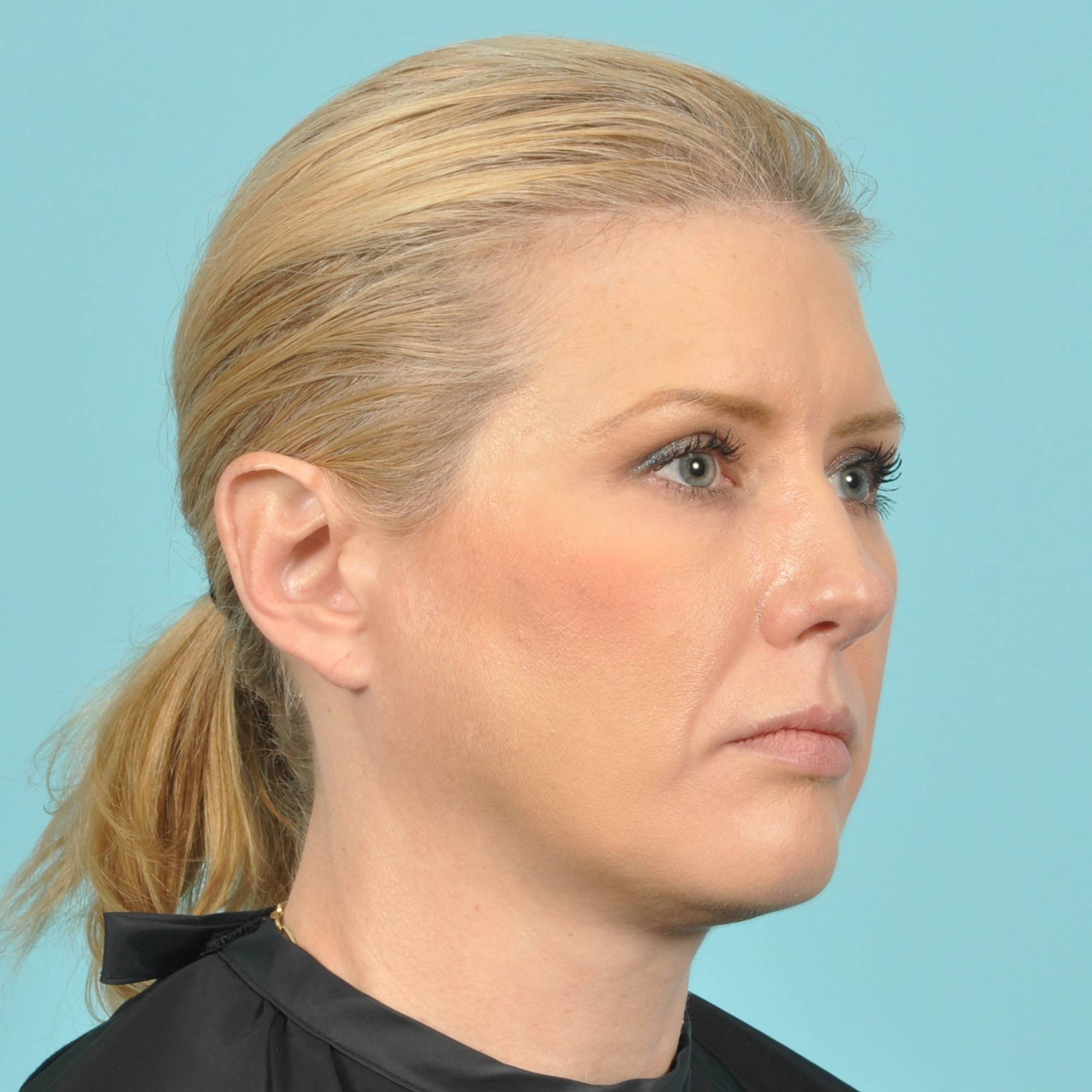 Blepharoplasty Before & After Image