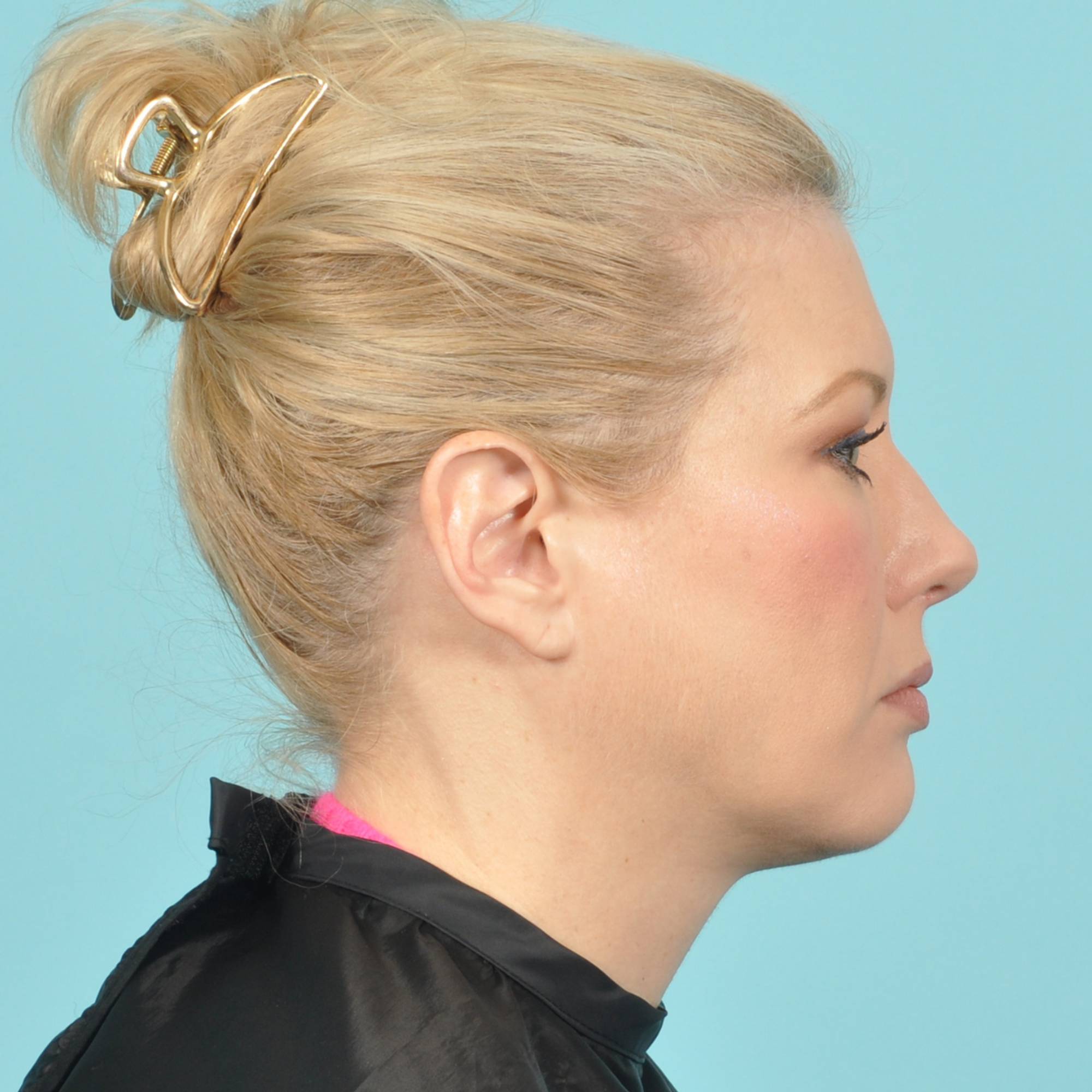 Blepharoplasty Before & After Image