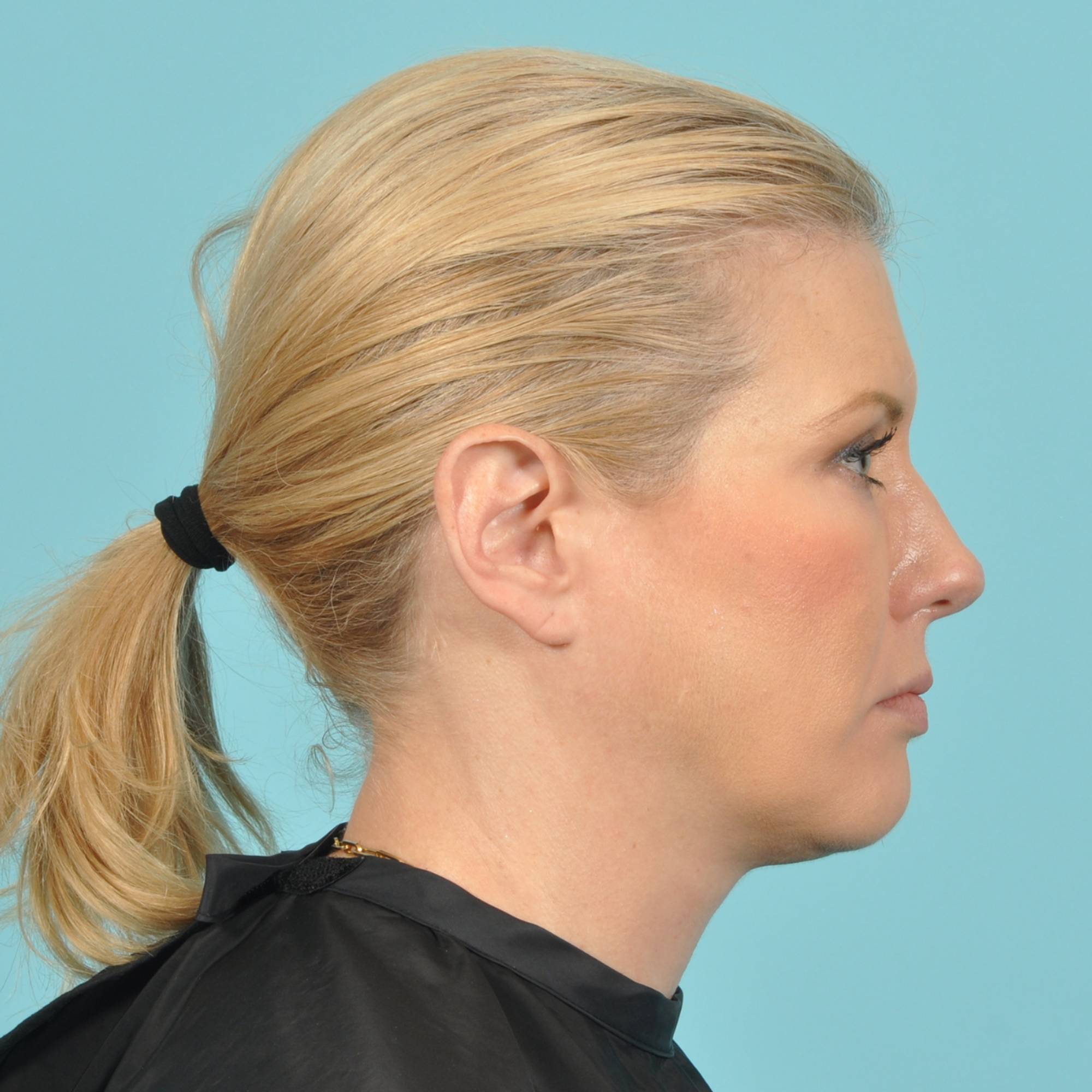 Blepharoplasty Before & After Image