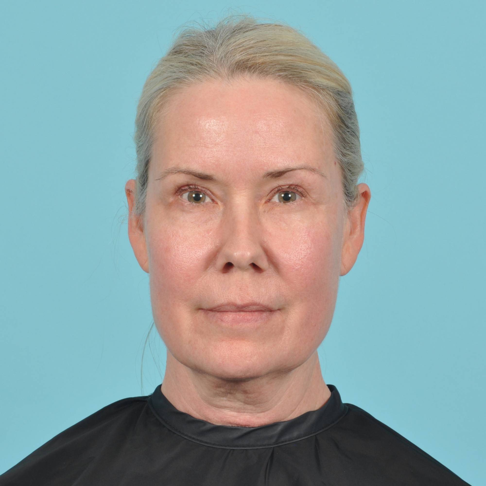 Blepharoplasty Before & After Image