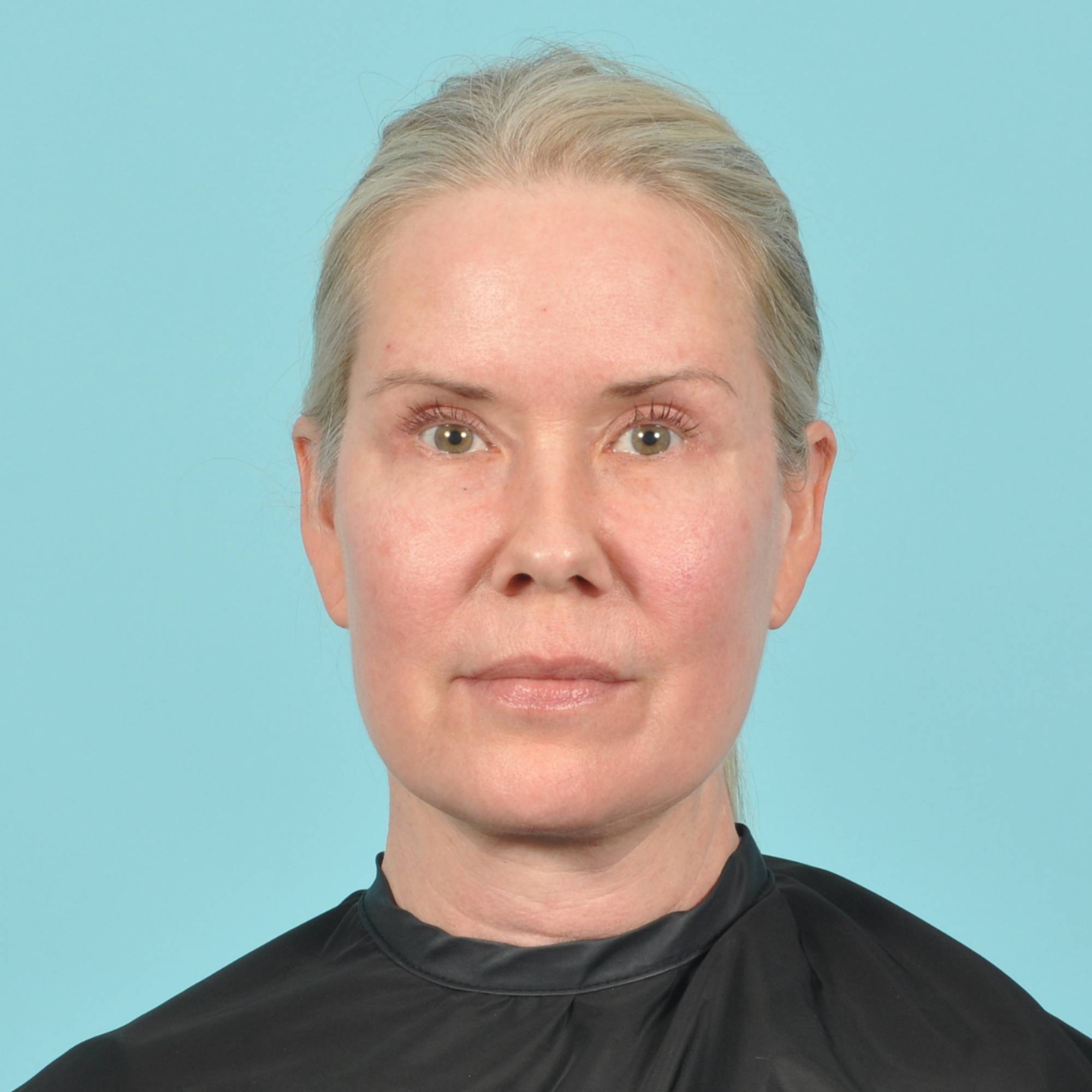 Blepharoplasty Before & After Image