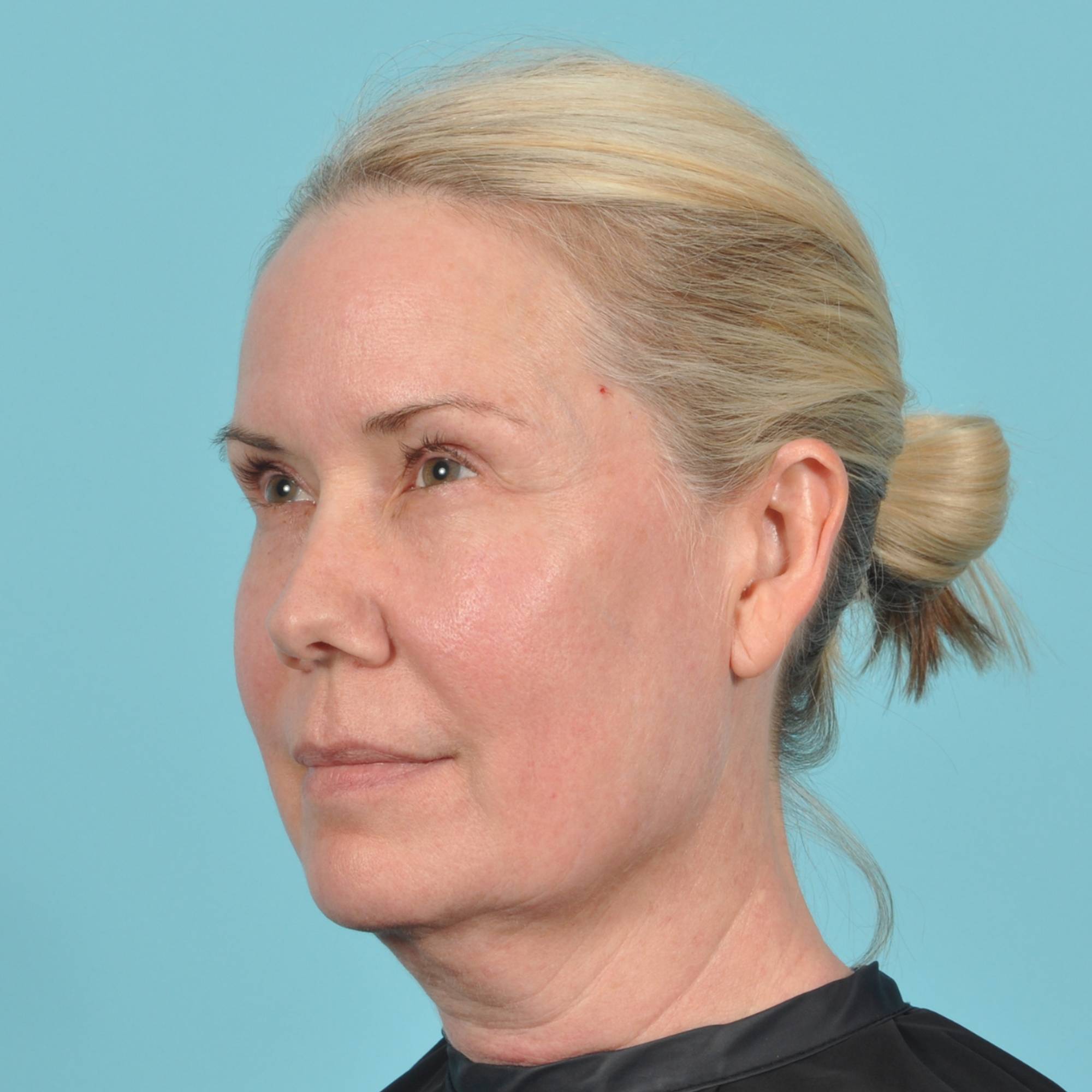 Blepharoplasty Before & After Image