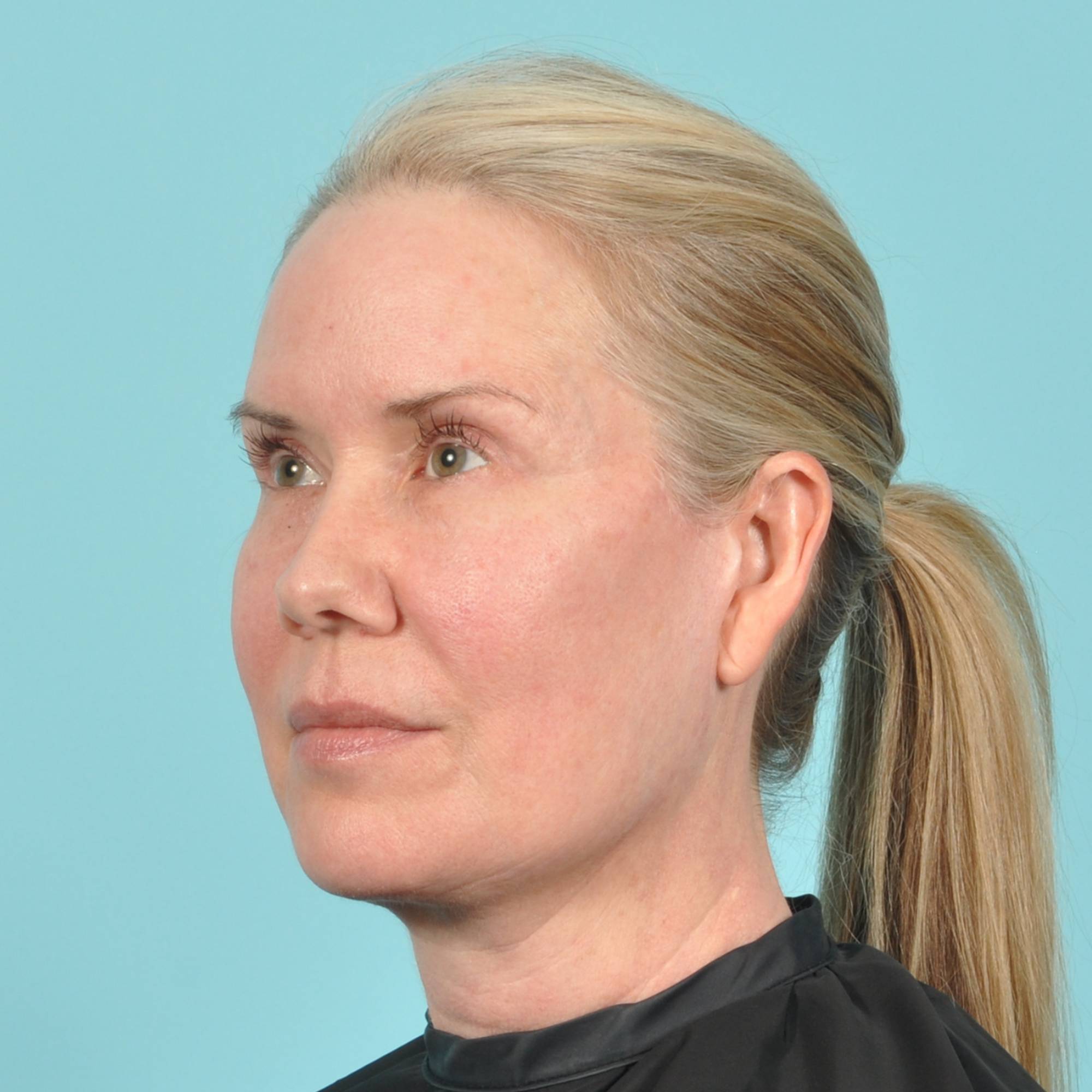 Blepharoplasty Before & After Image