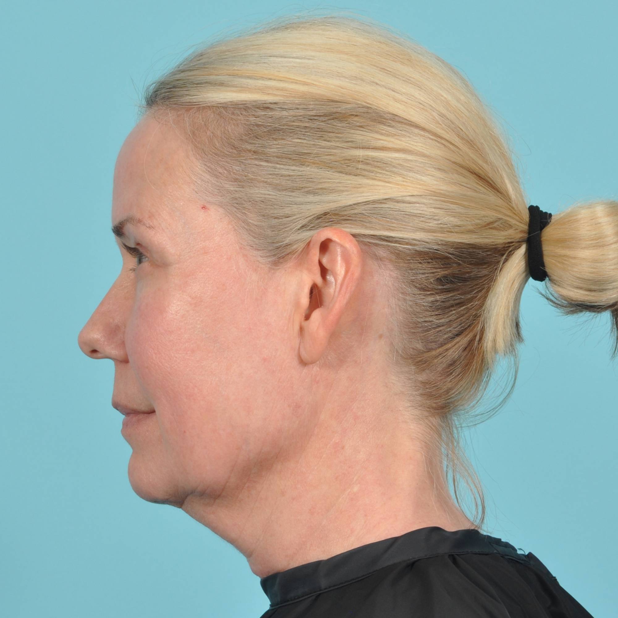 Blepharoplasty Before & After Image