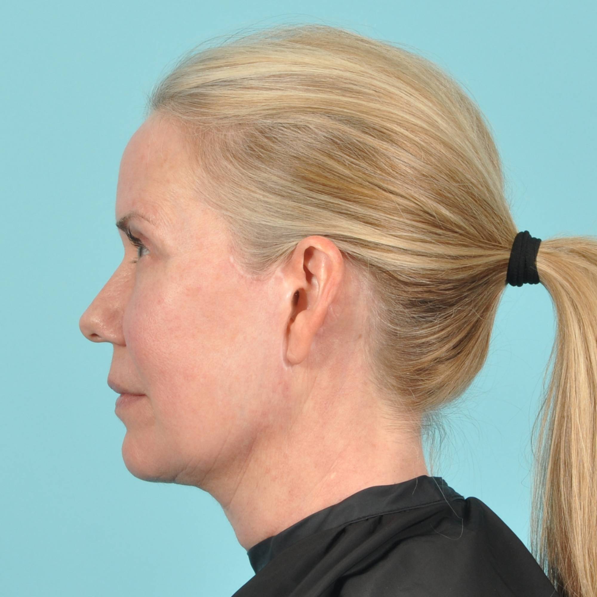 Blepharoplasty Before & After Image