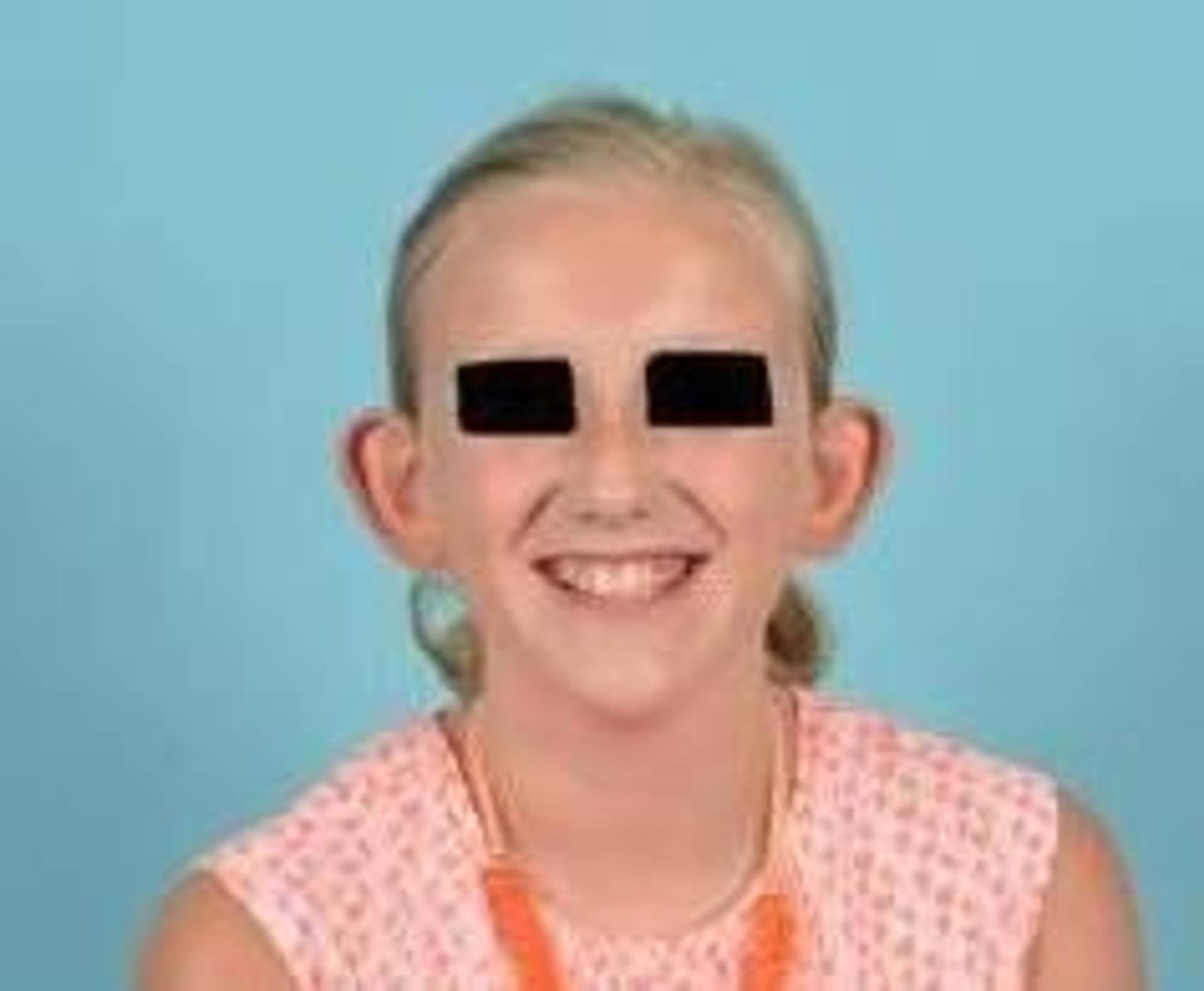 Ear Surgery Before & After Image