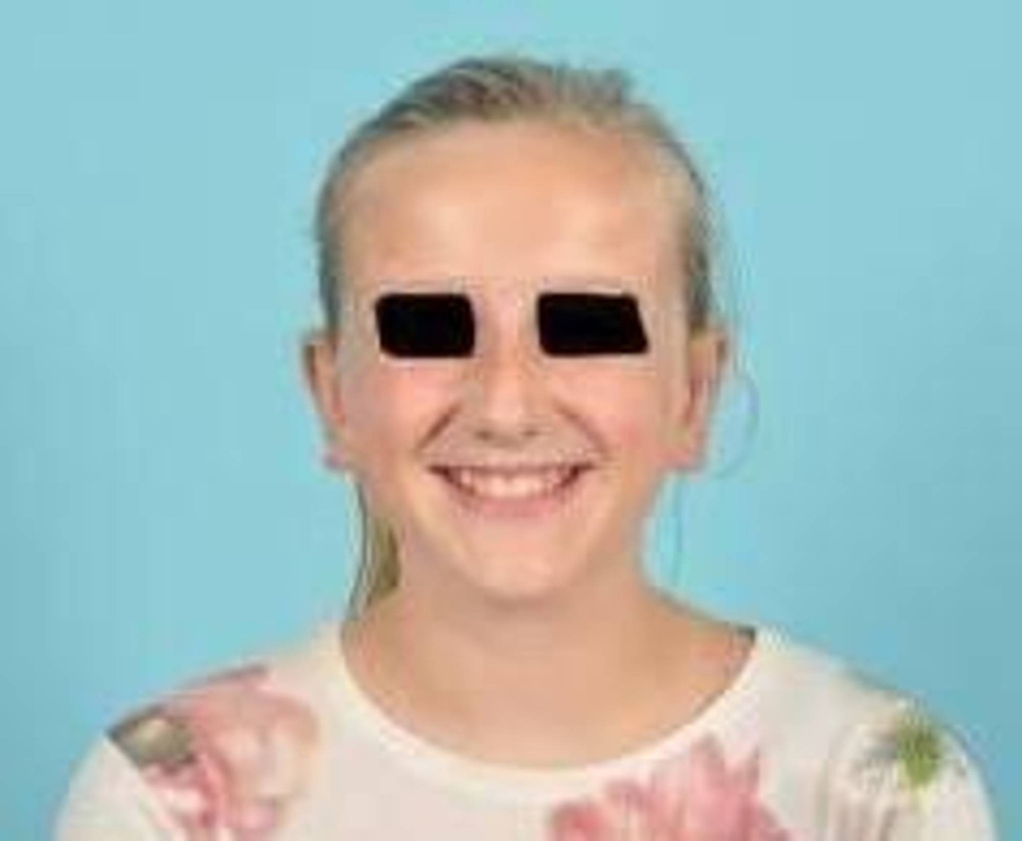 Ear Surgery Before & After Image