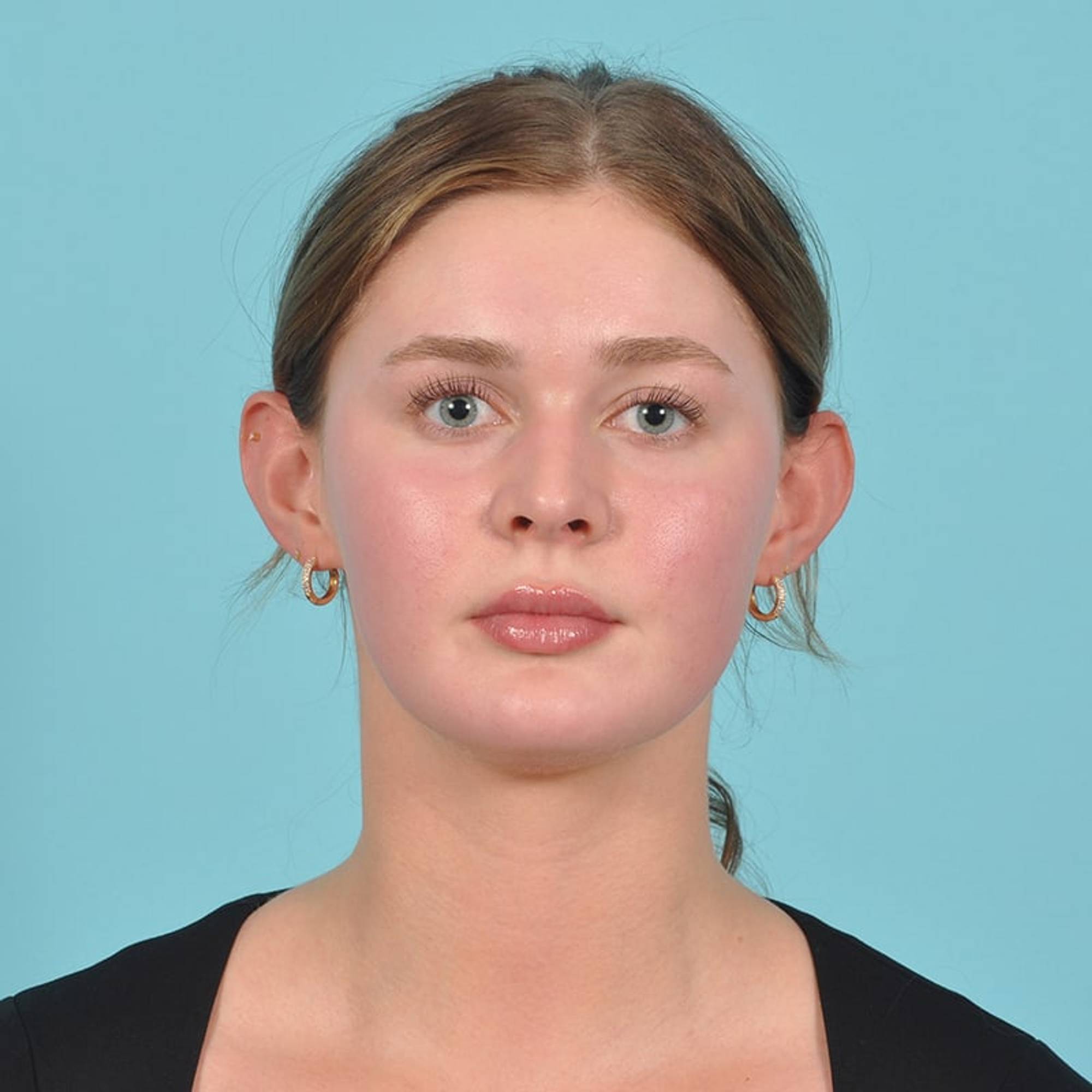 Ear Surgery Before & After Image