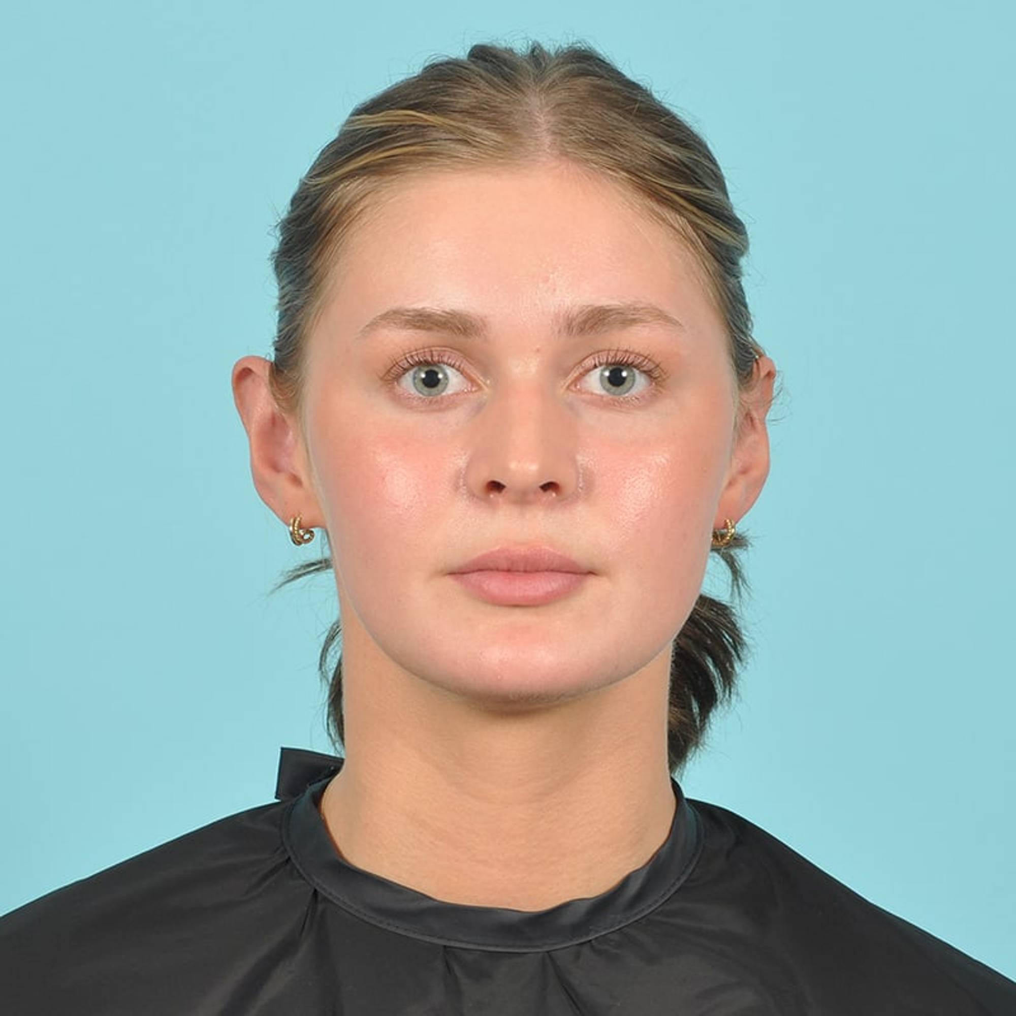 Ear Surgery Before & After Image