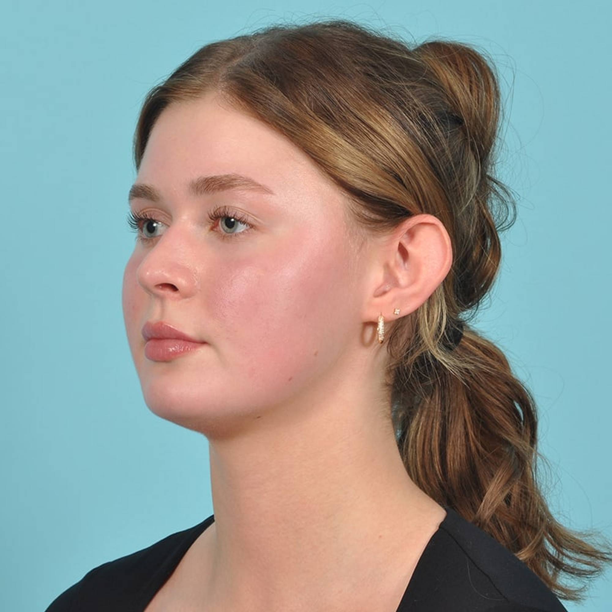 Ear Surgery Before & After Image