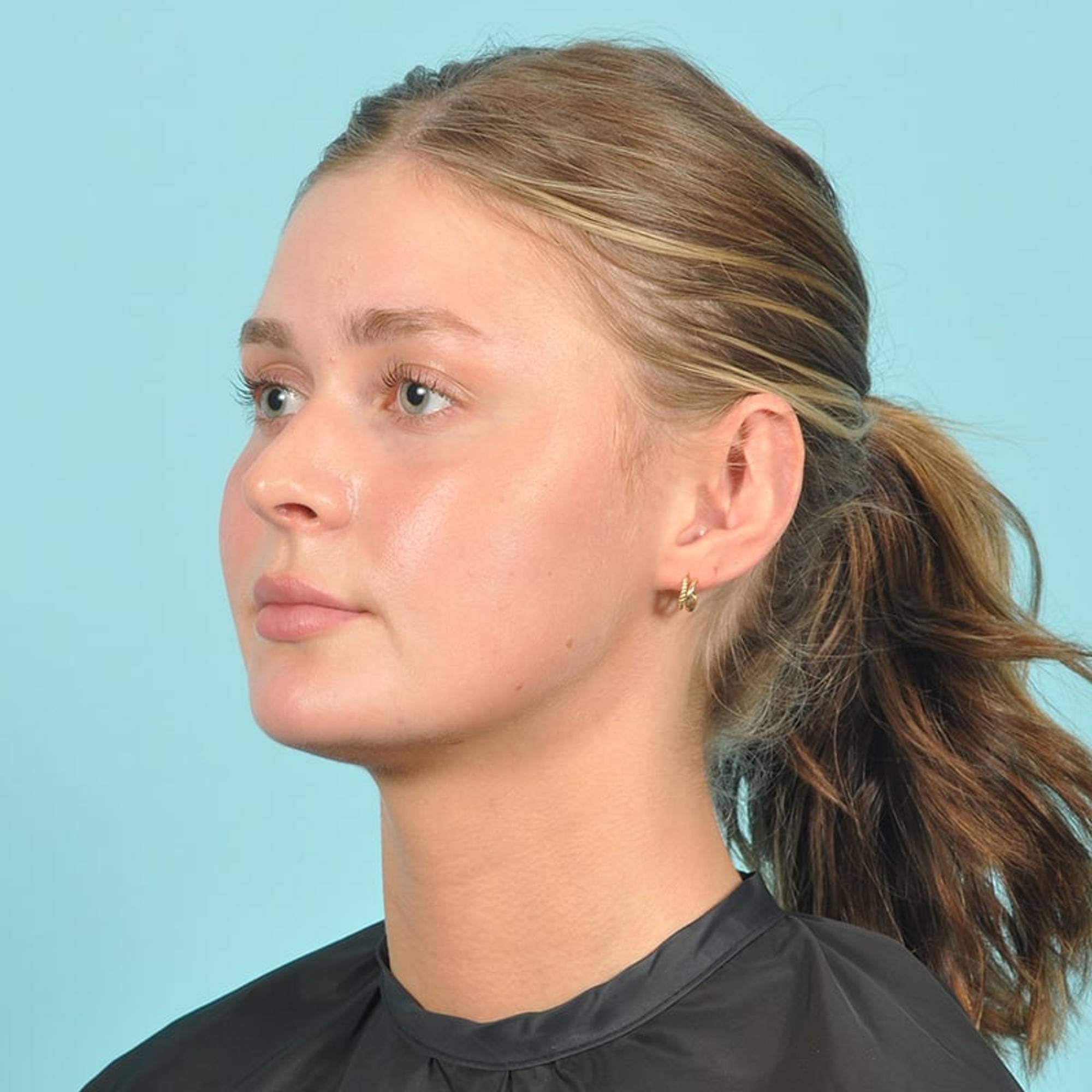 Ear Surgery Before & After Image