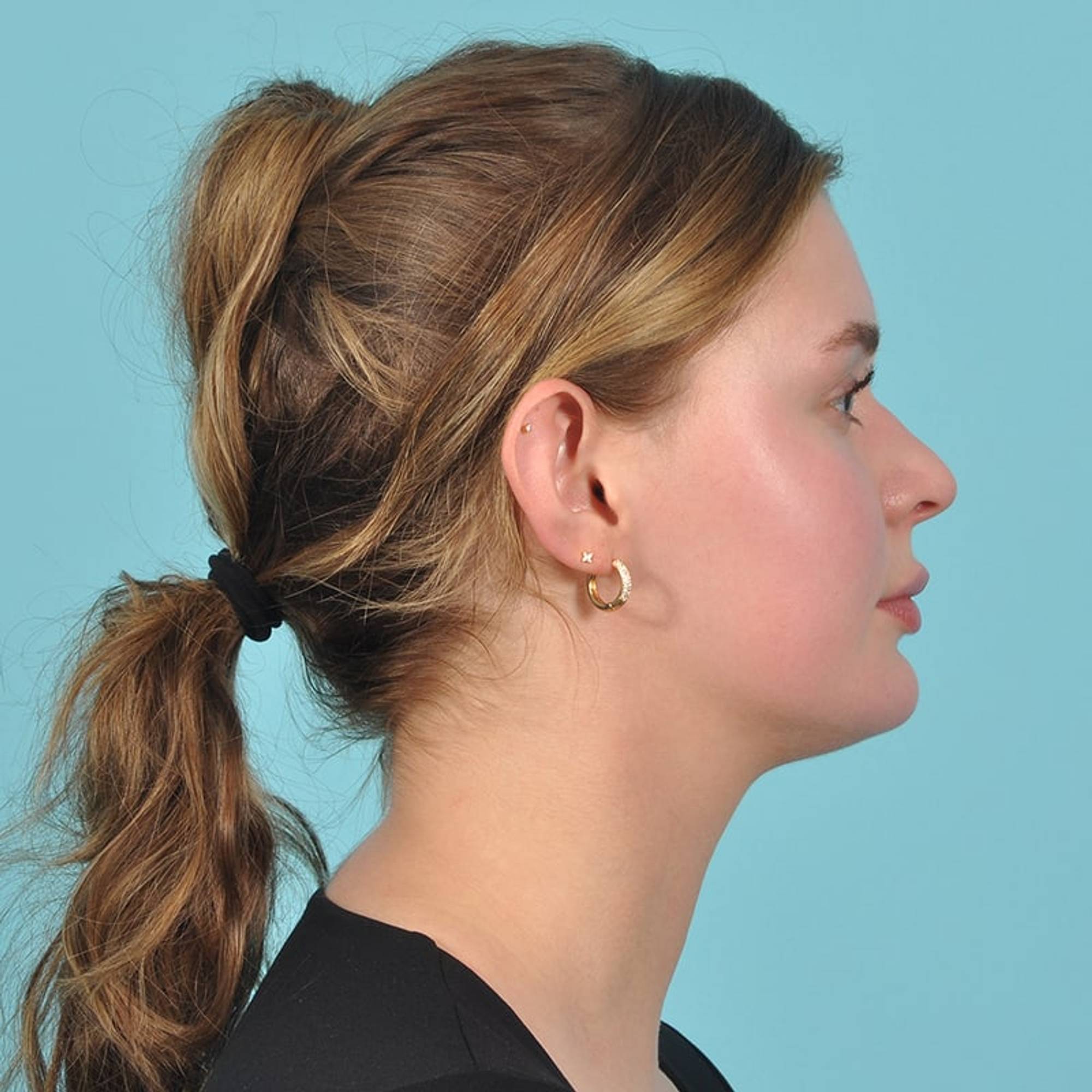 Ear Surgery Before & After Image