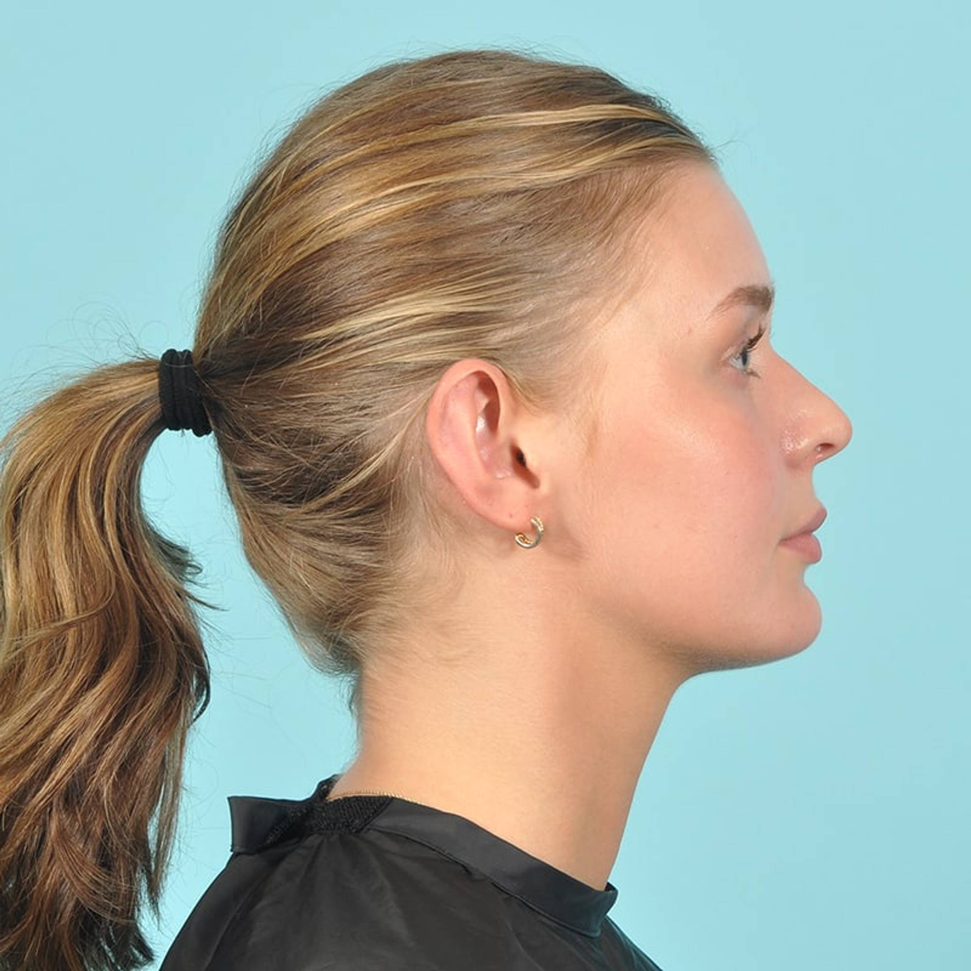 Ear Surgery Before & After Image