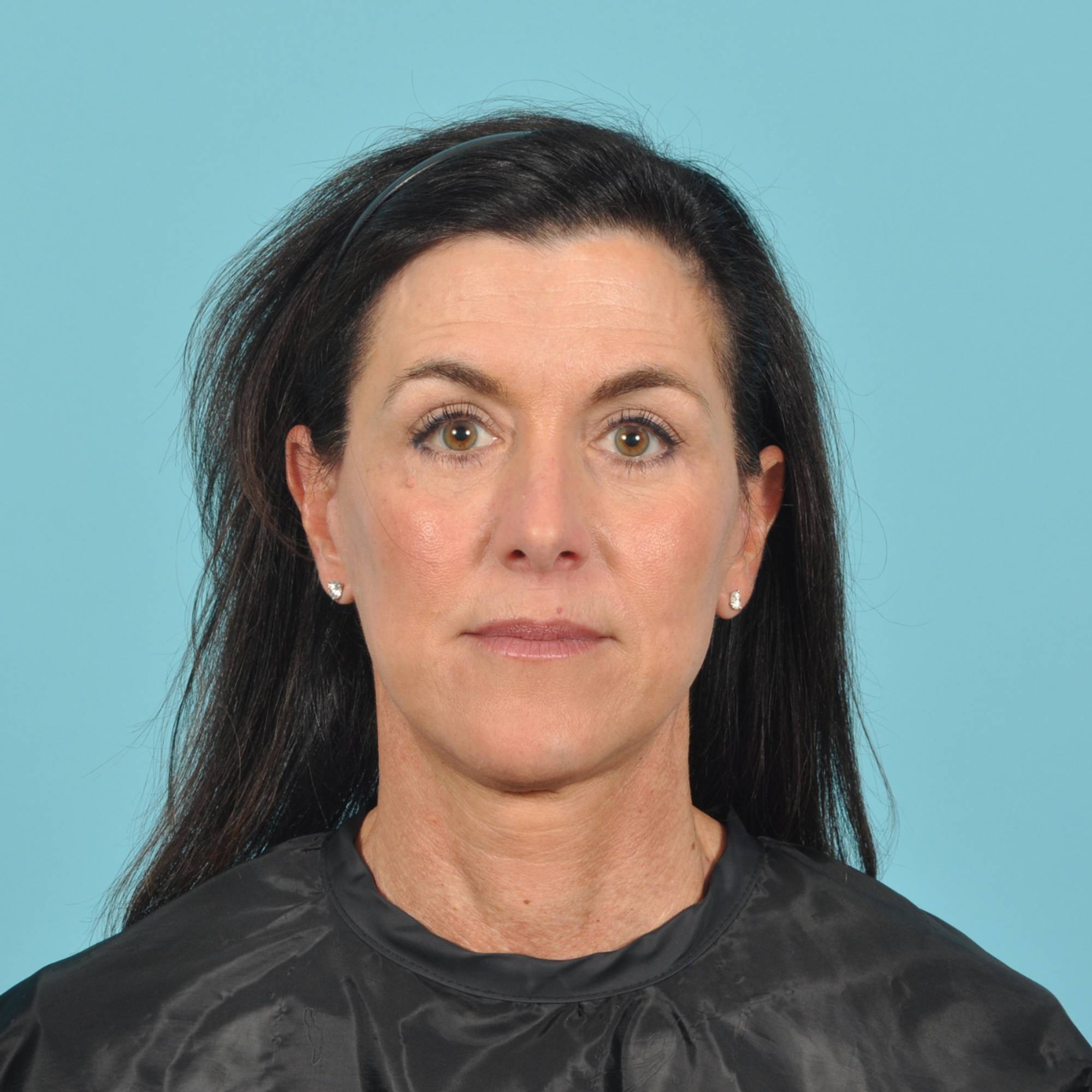 Facelift Before & After Image