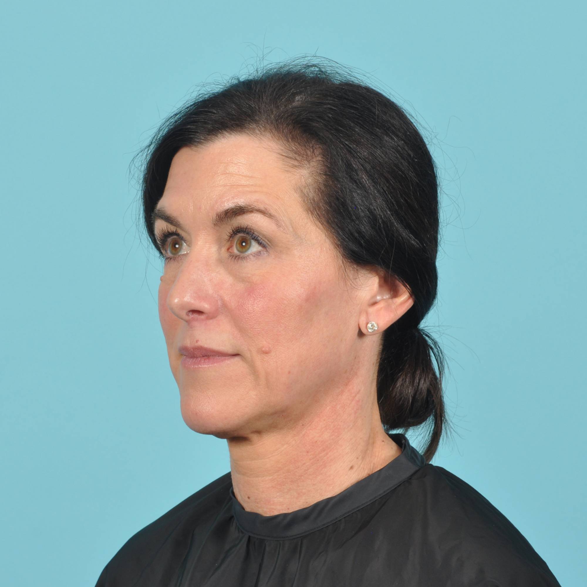 Facelift Before & After Image