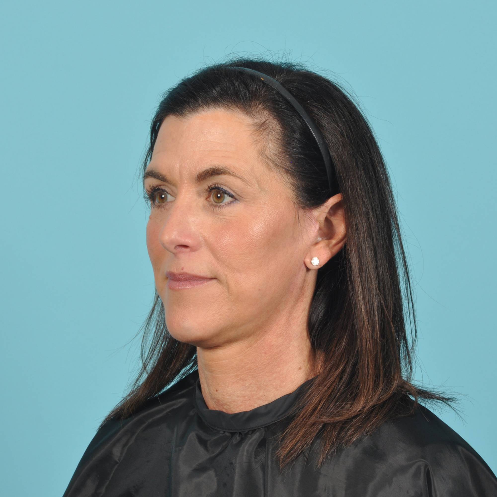 Facelift Before & After Image