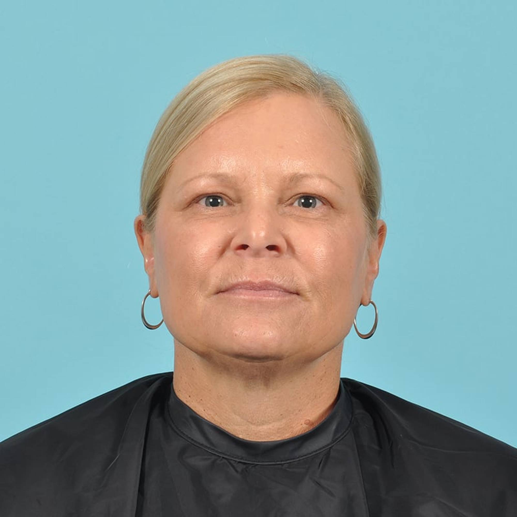 Facelift Before & After Image