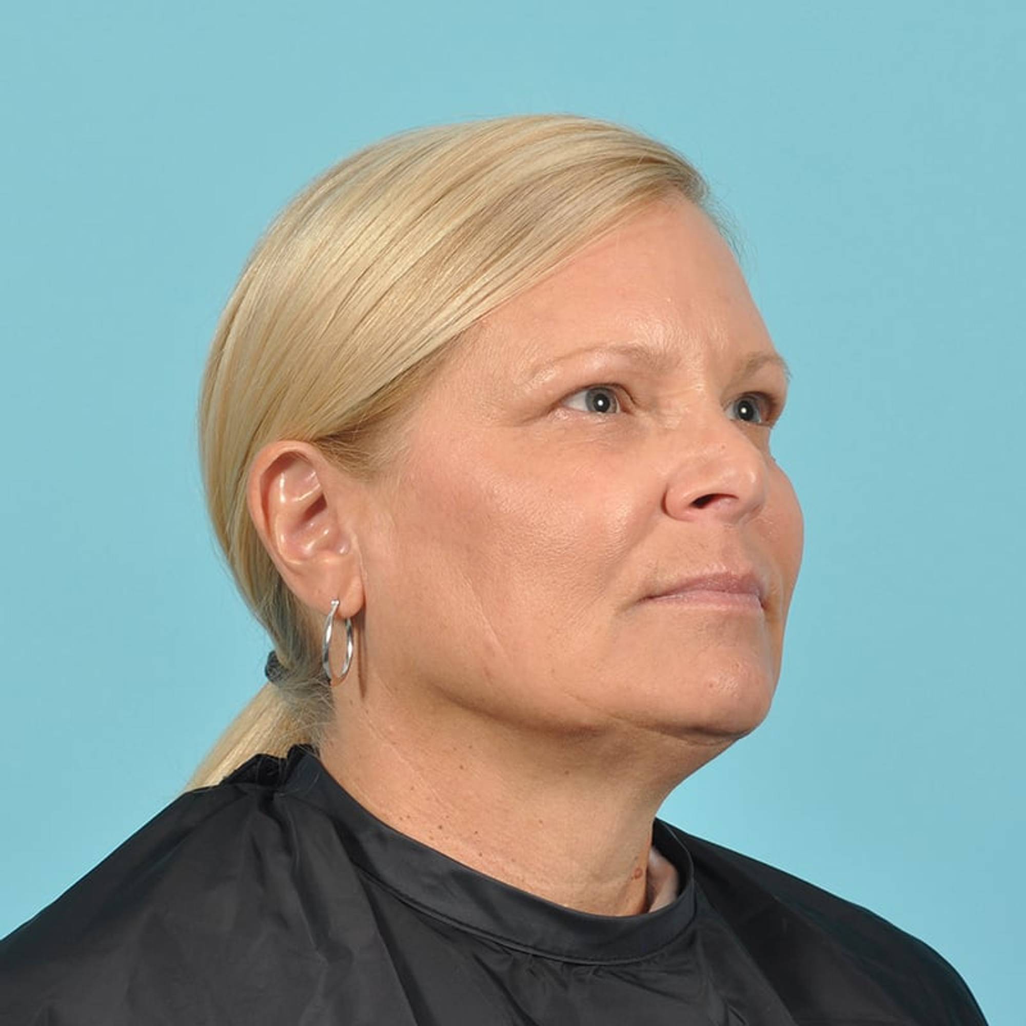  Before & After Image