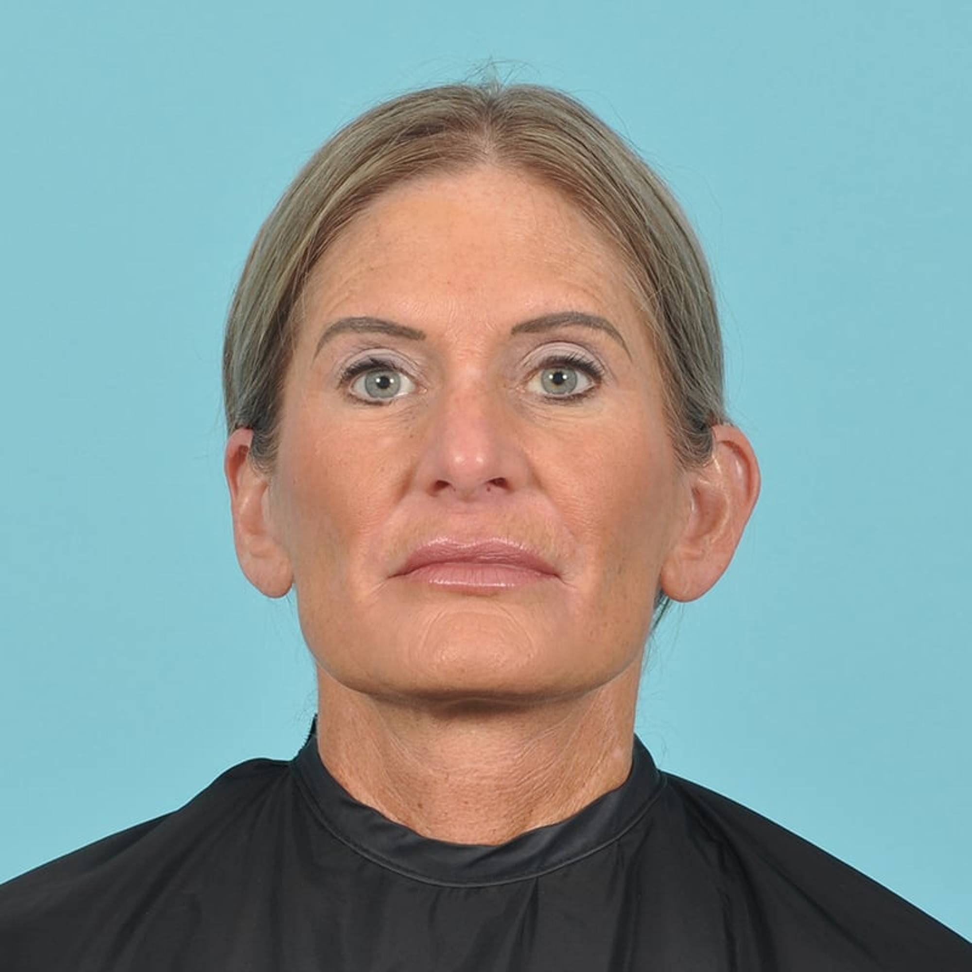 Facelift Before & After Image