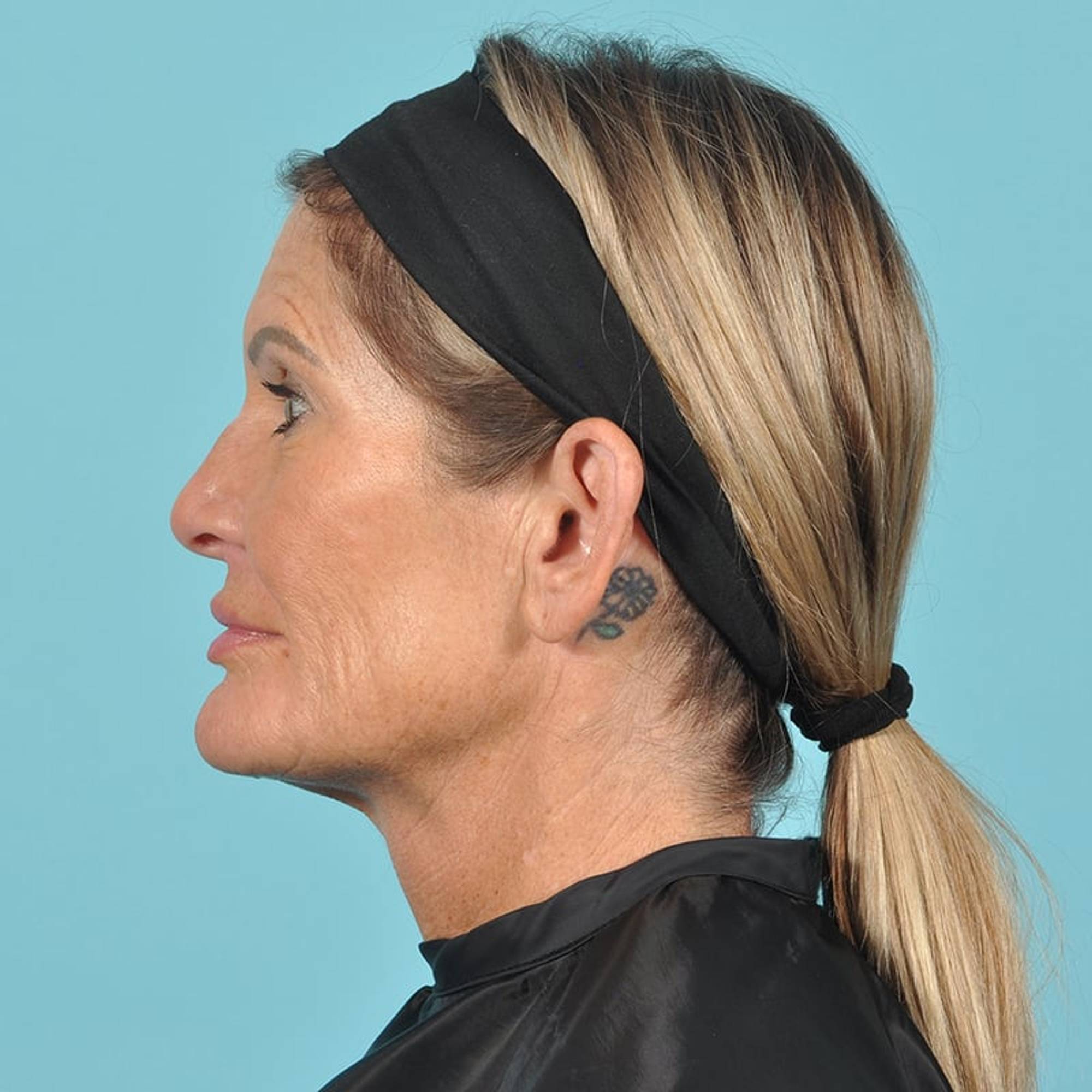 Facelift Before & After Image