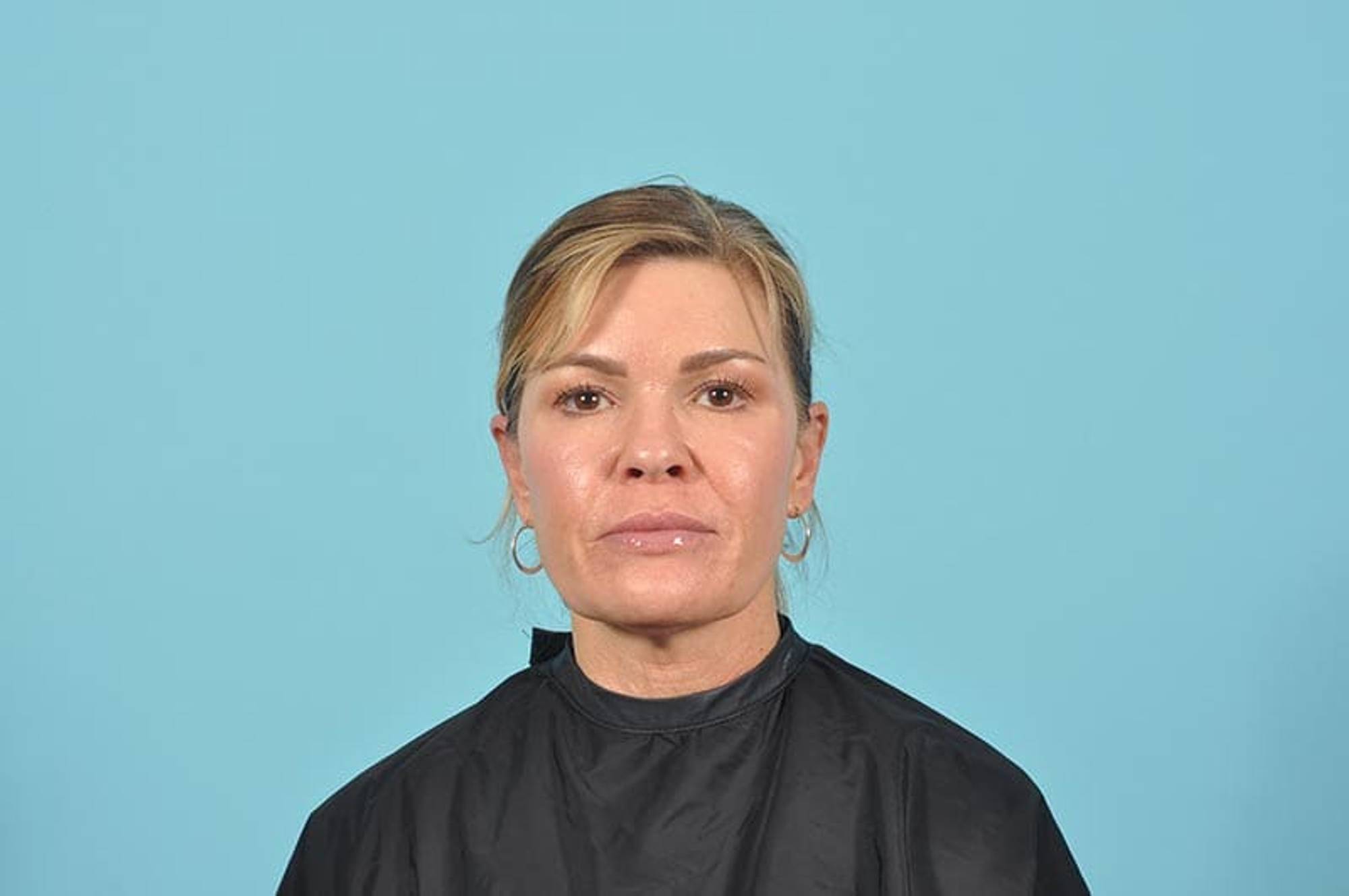 Facelift Before & After Image