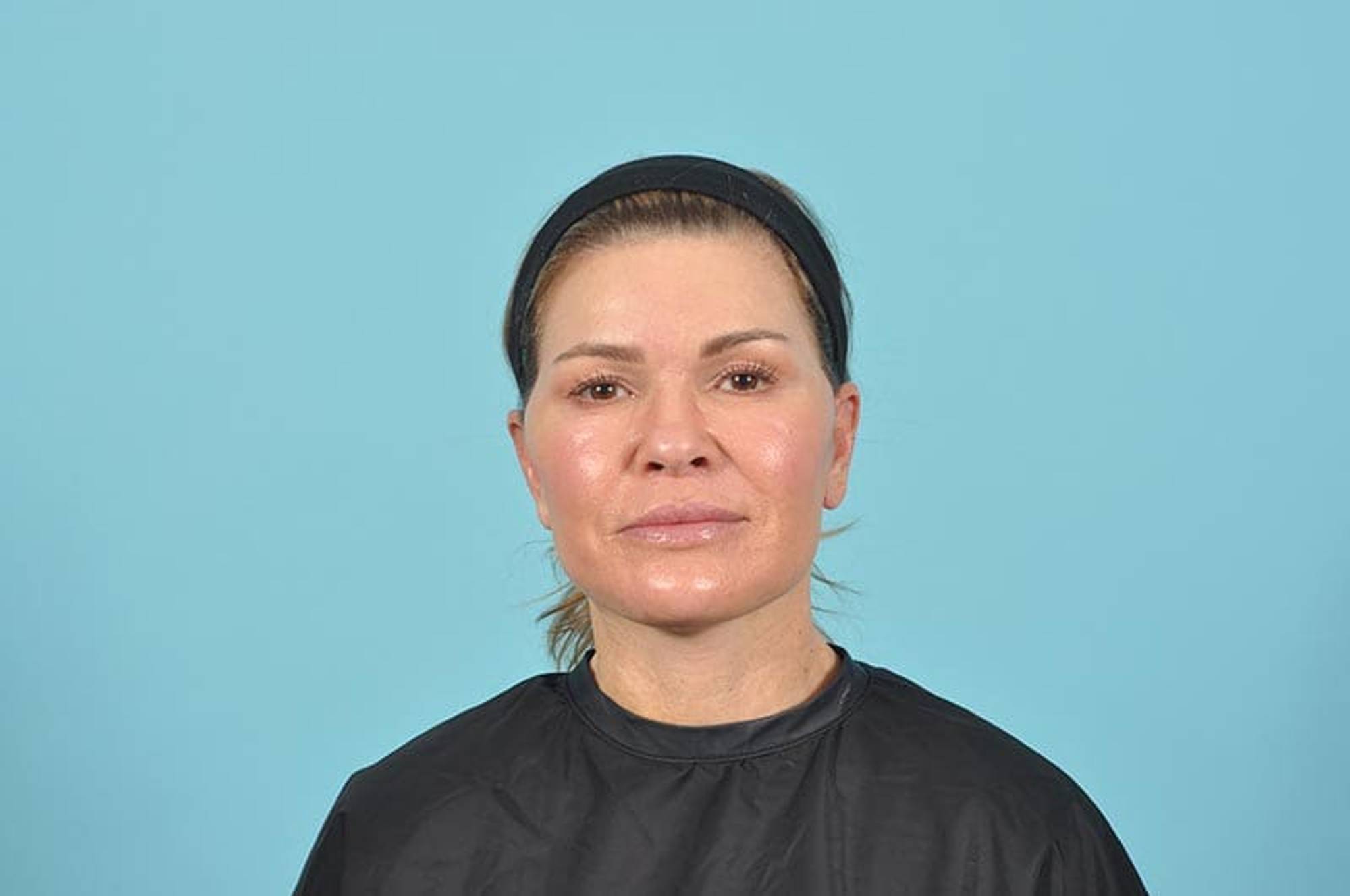 Facelift Before & After Image