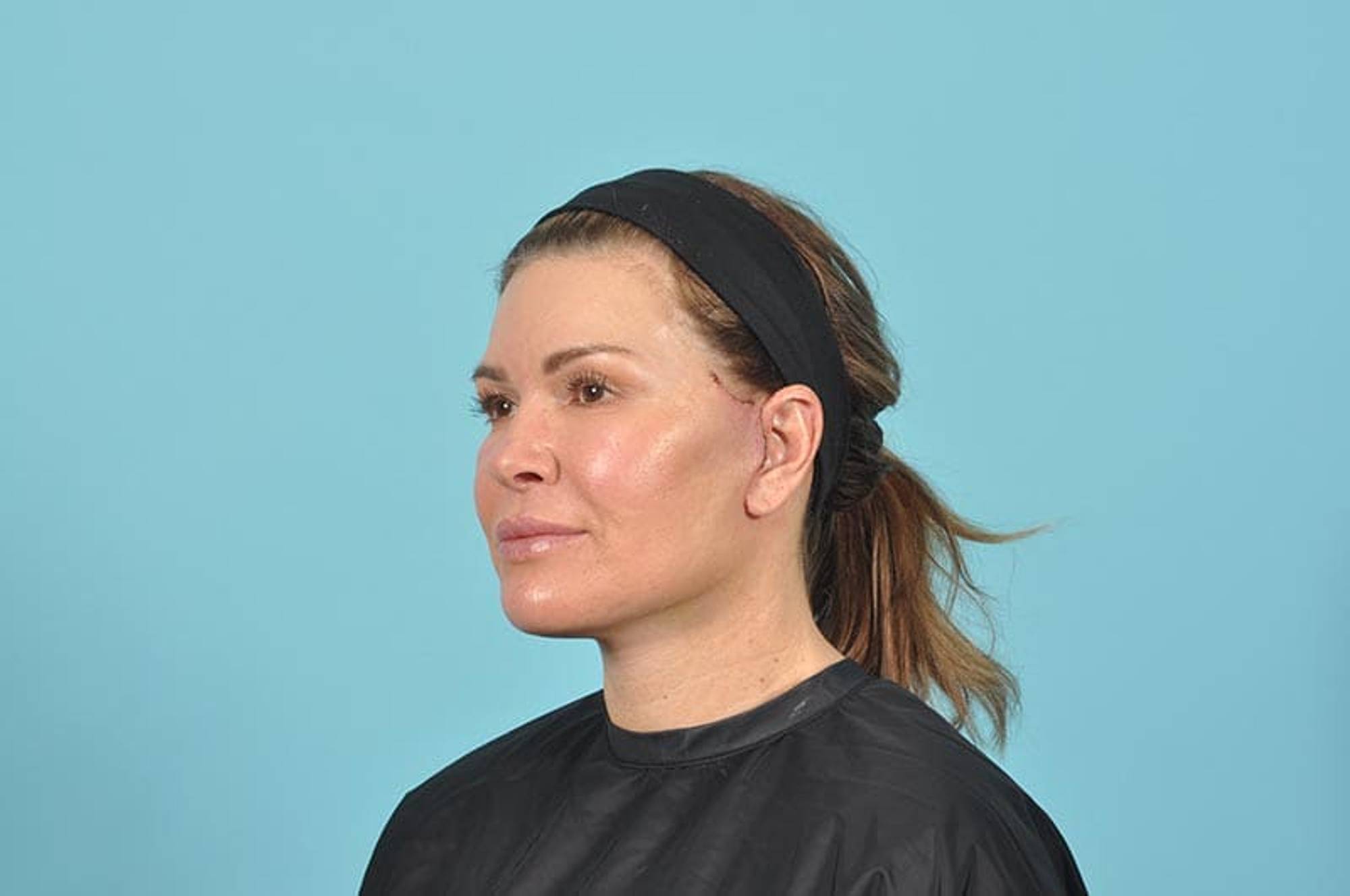 Facelift Before & After Image