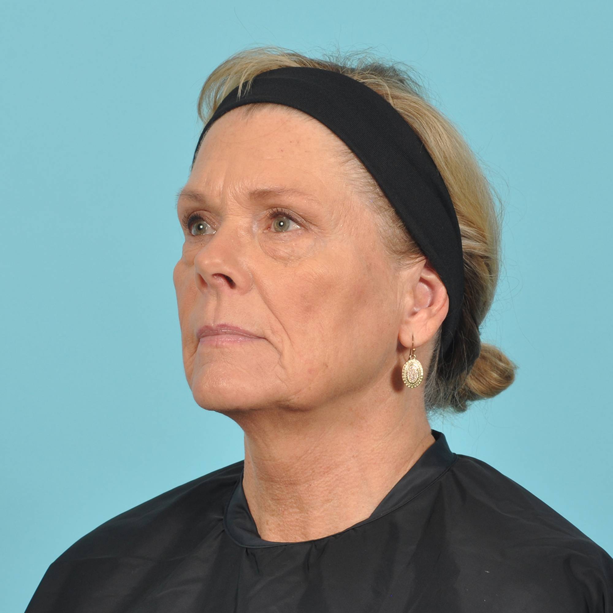 Facelift Before & After Image