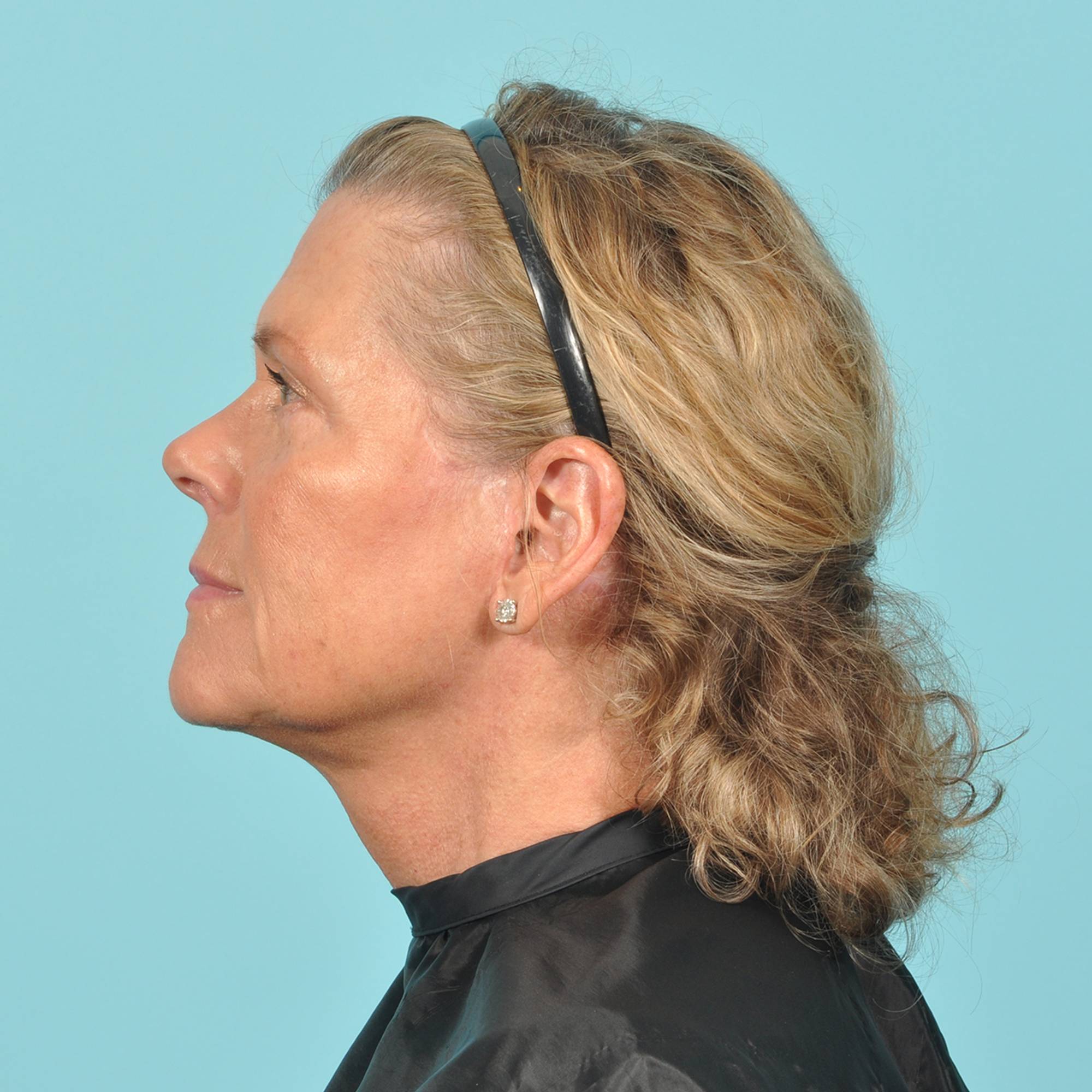 Facelift Before & After Image