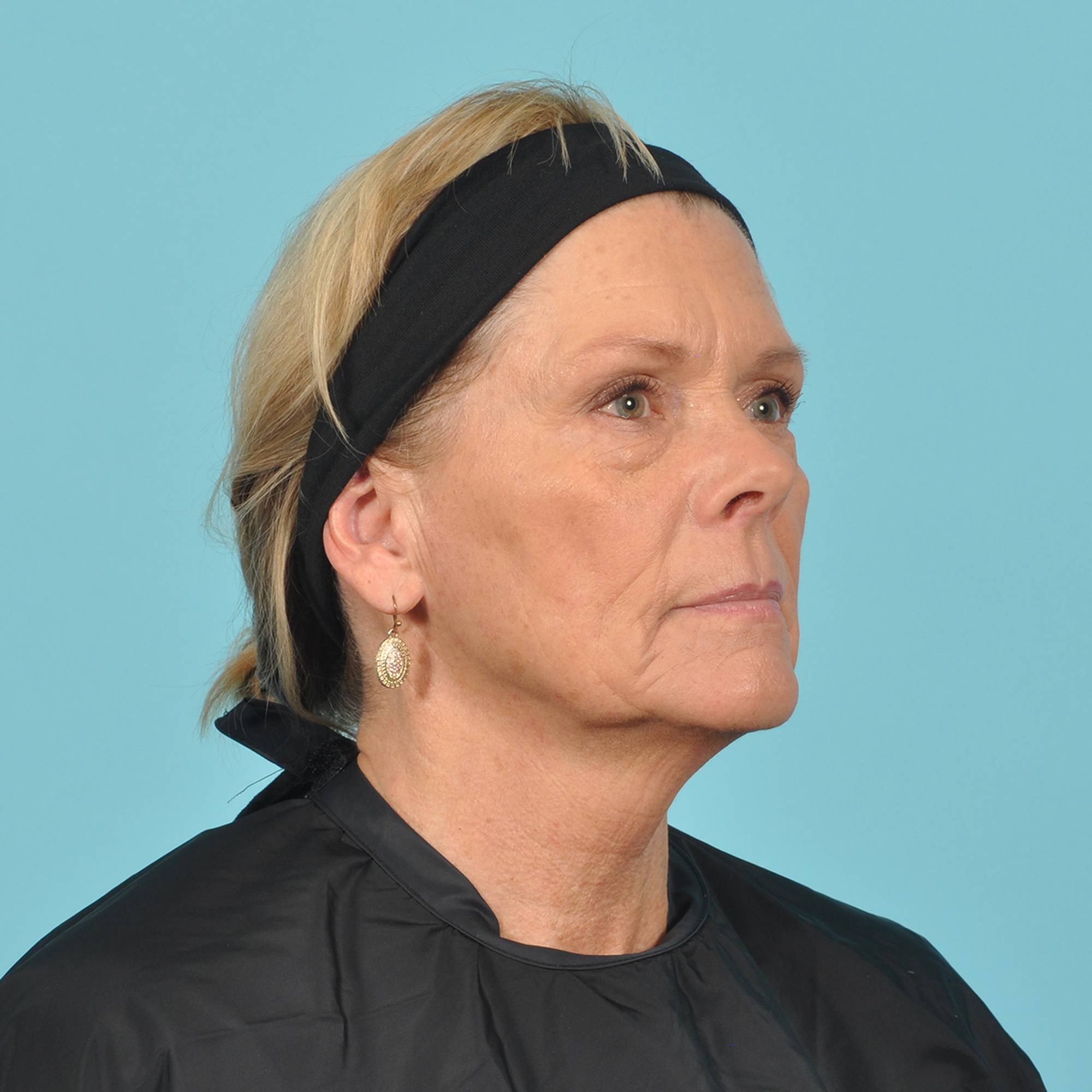  Before & After Image