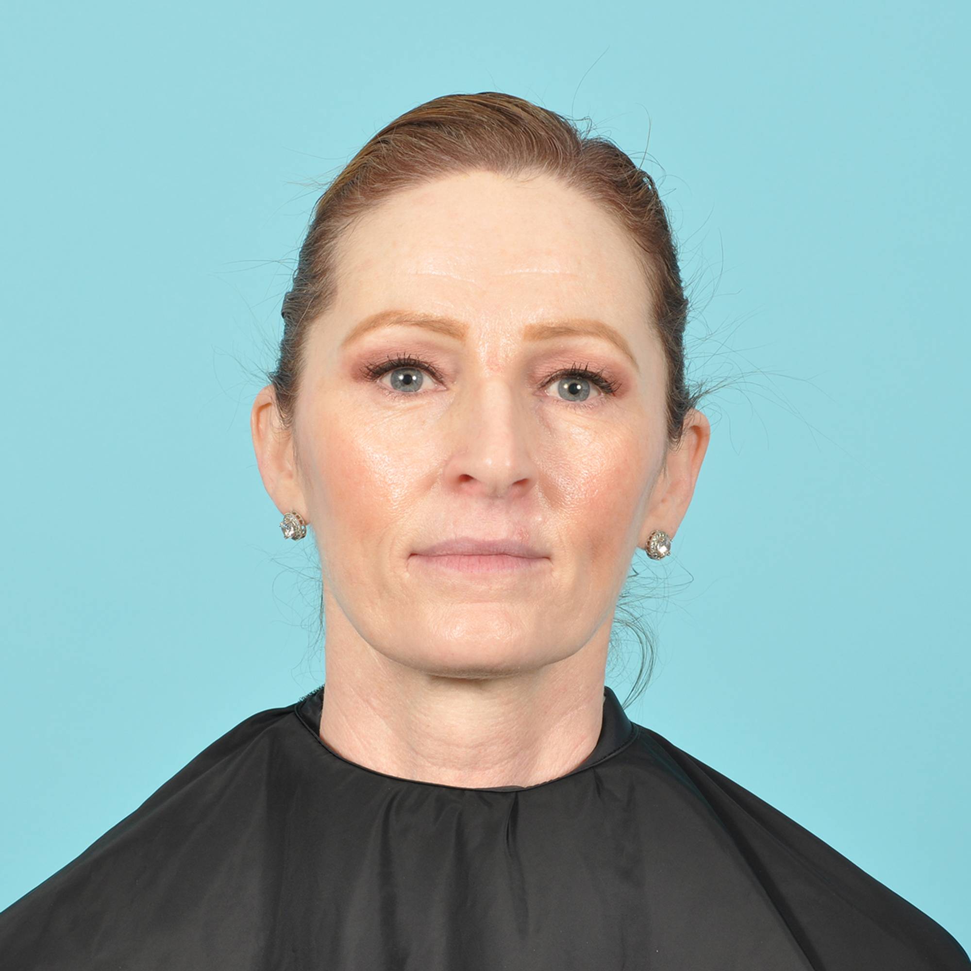 Facelift Before & After Image