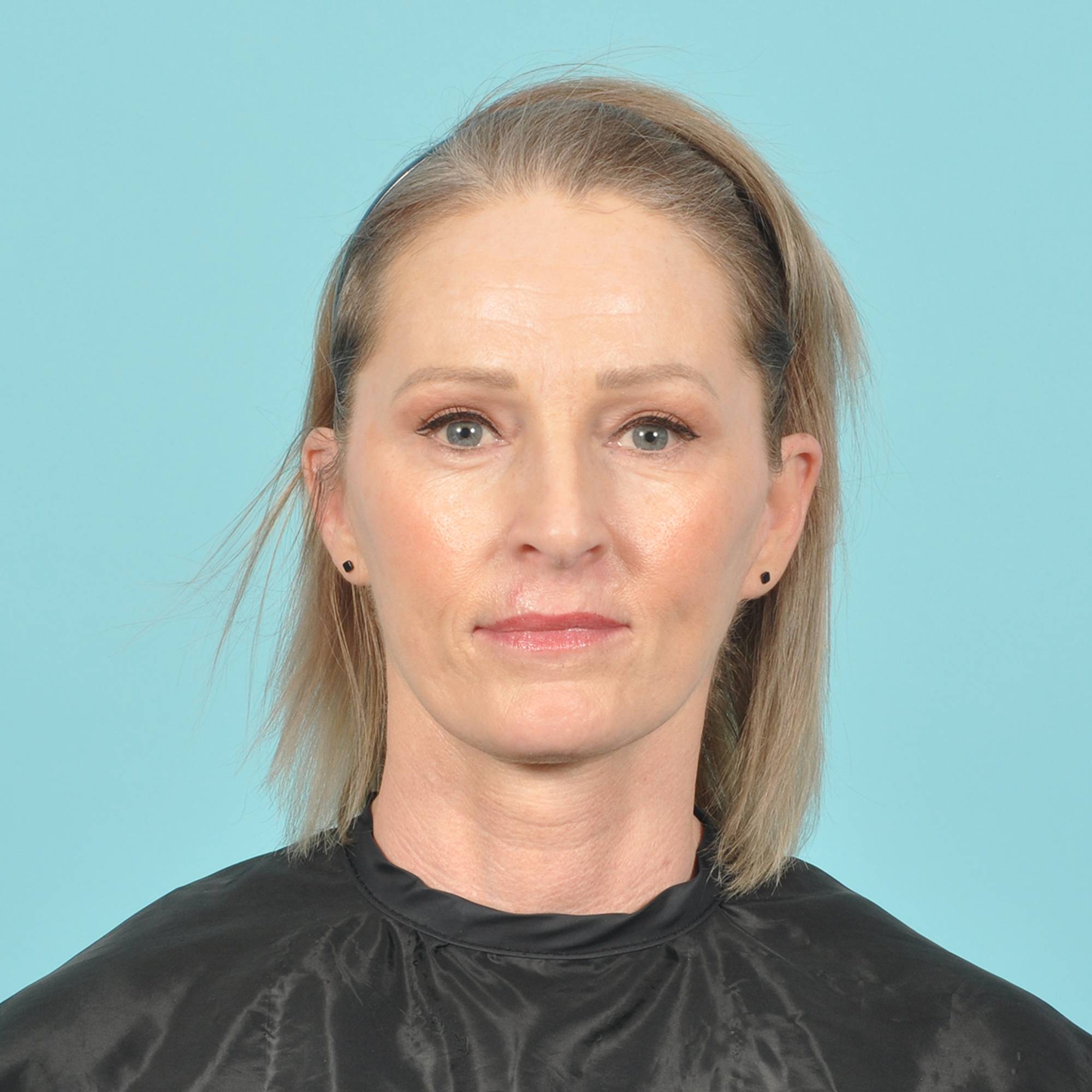 Facelift Before & After Image