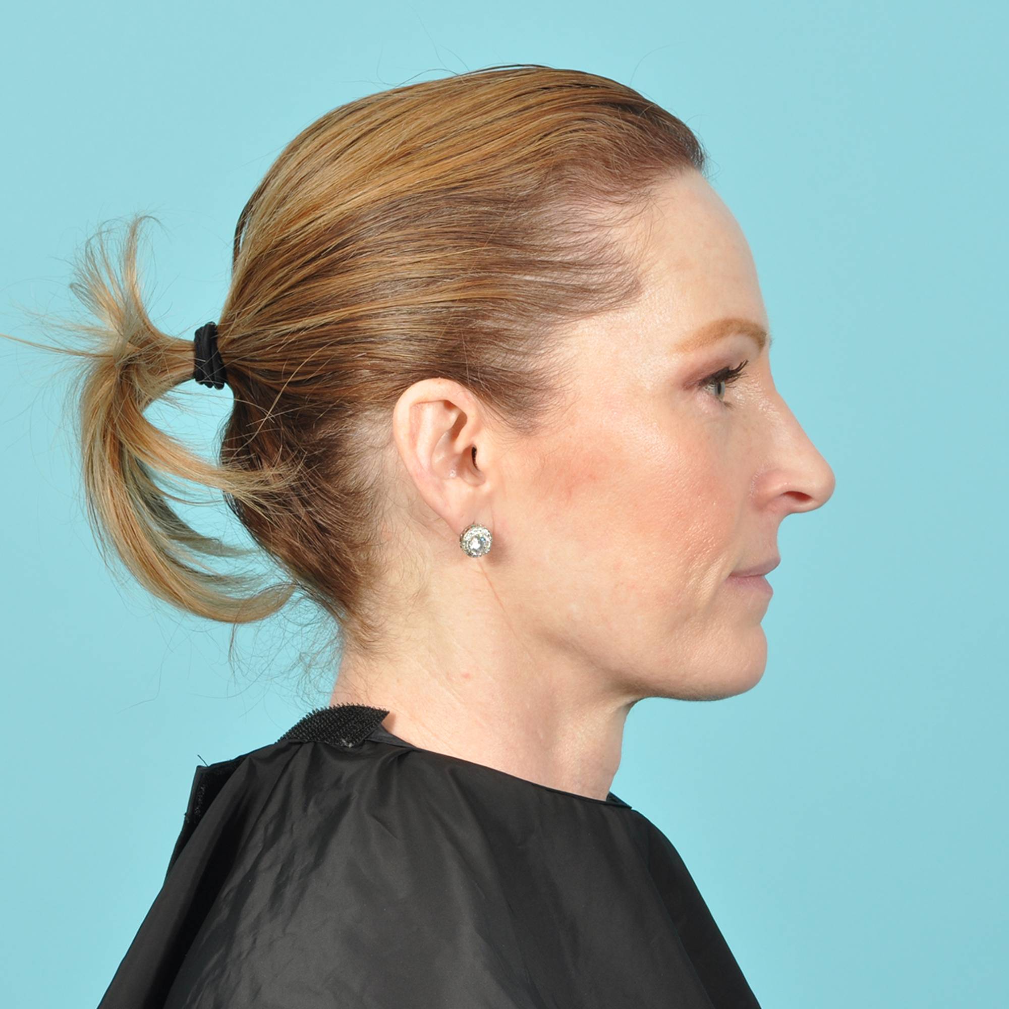 Facelift Before & After Image