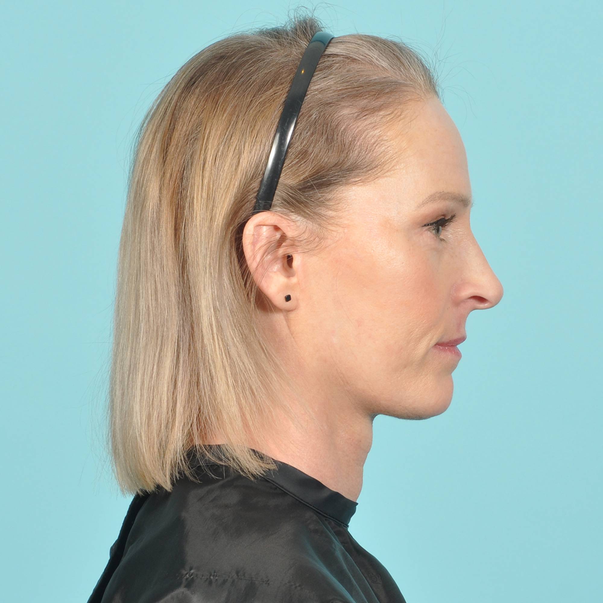 Facelift Before & After Image