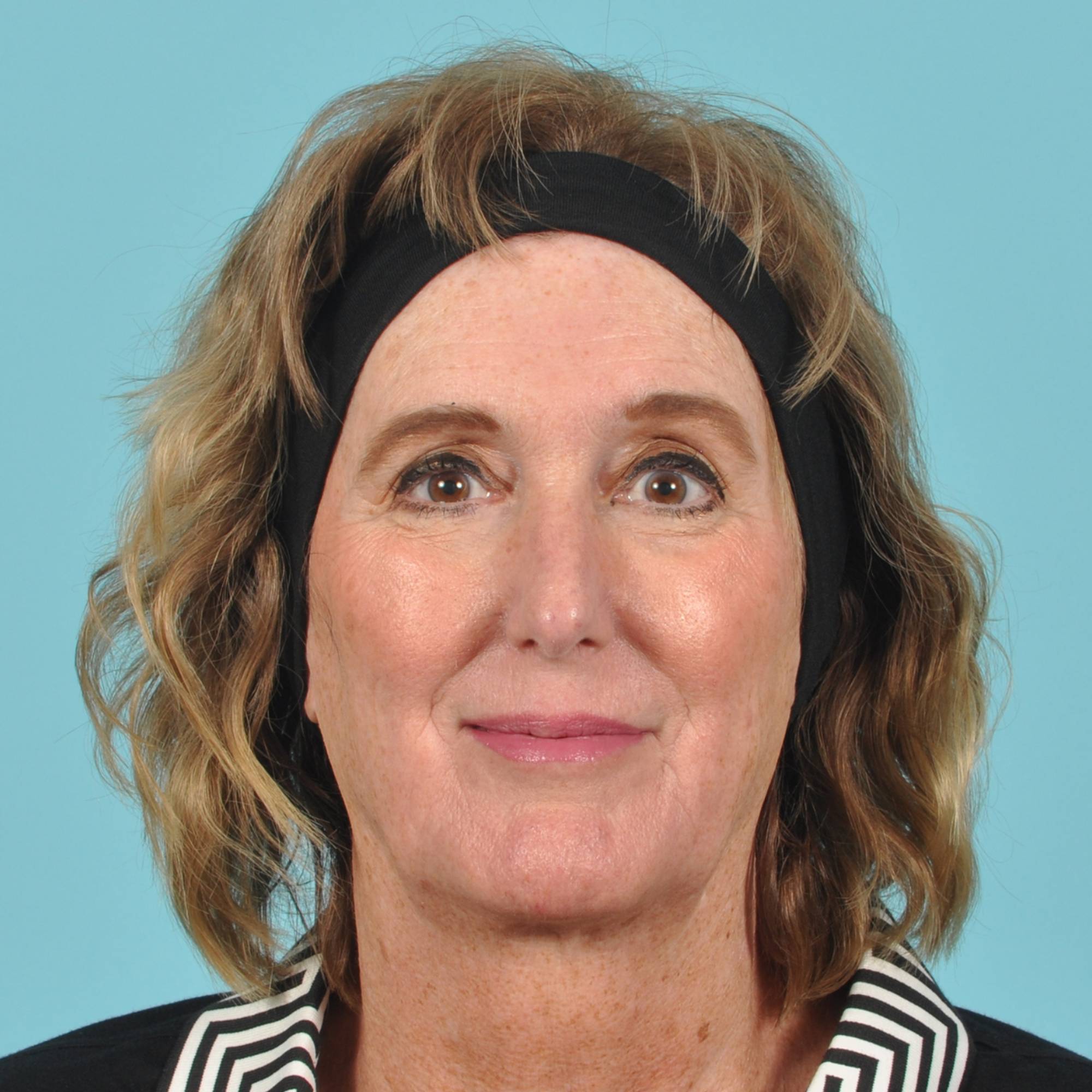 Facelift Before & After Image