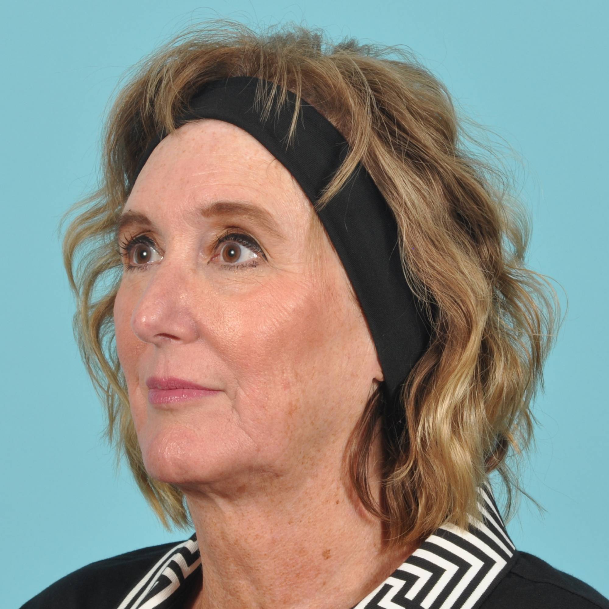 Facelift Before & After Image