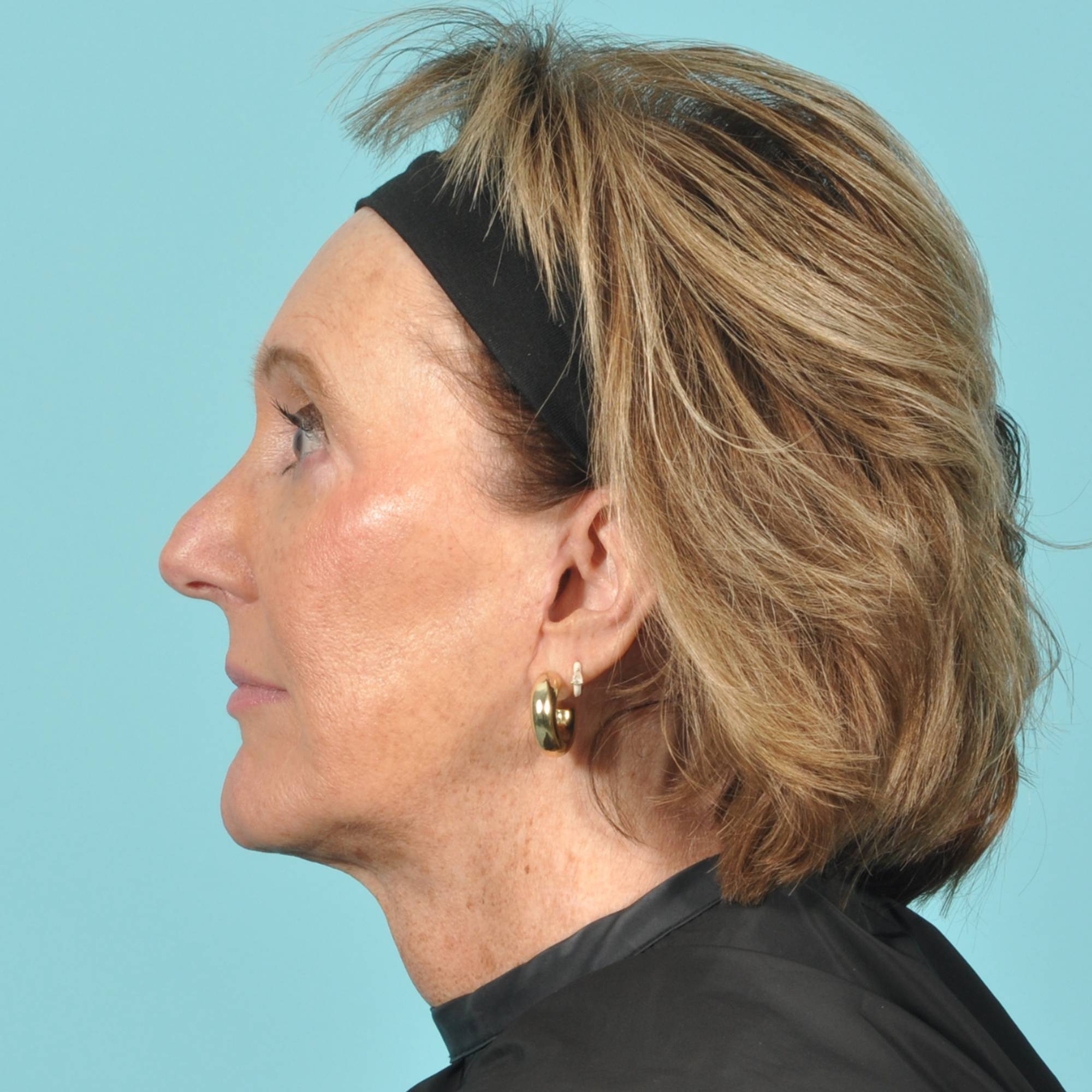Facelift Before & After Image