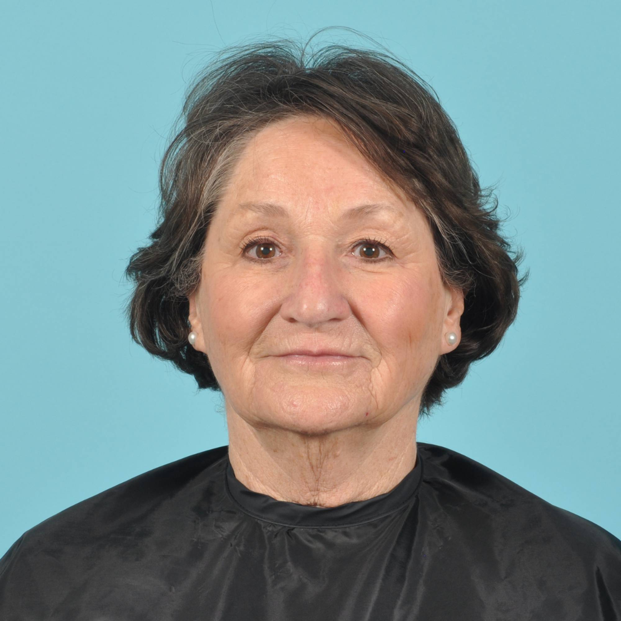 Facelift Before & After Image