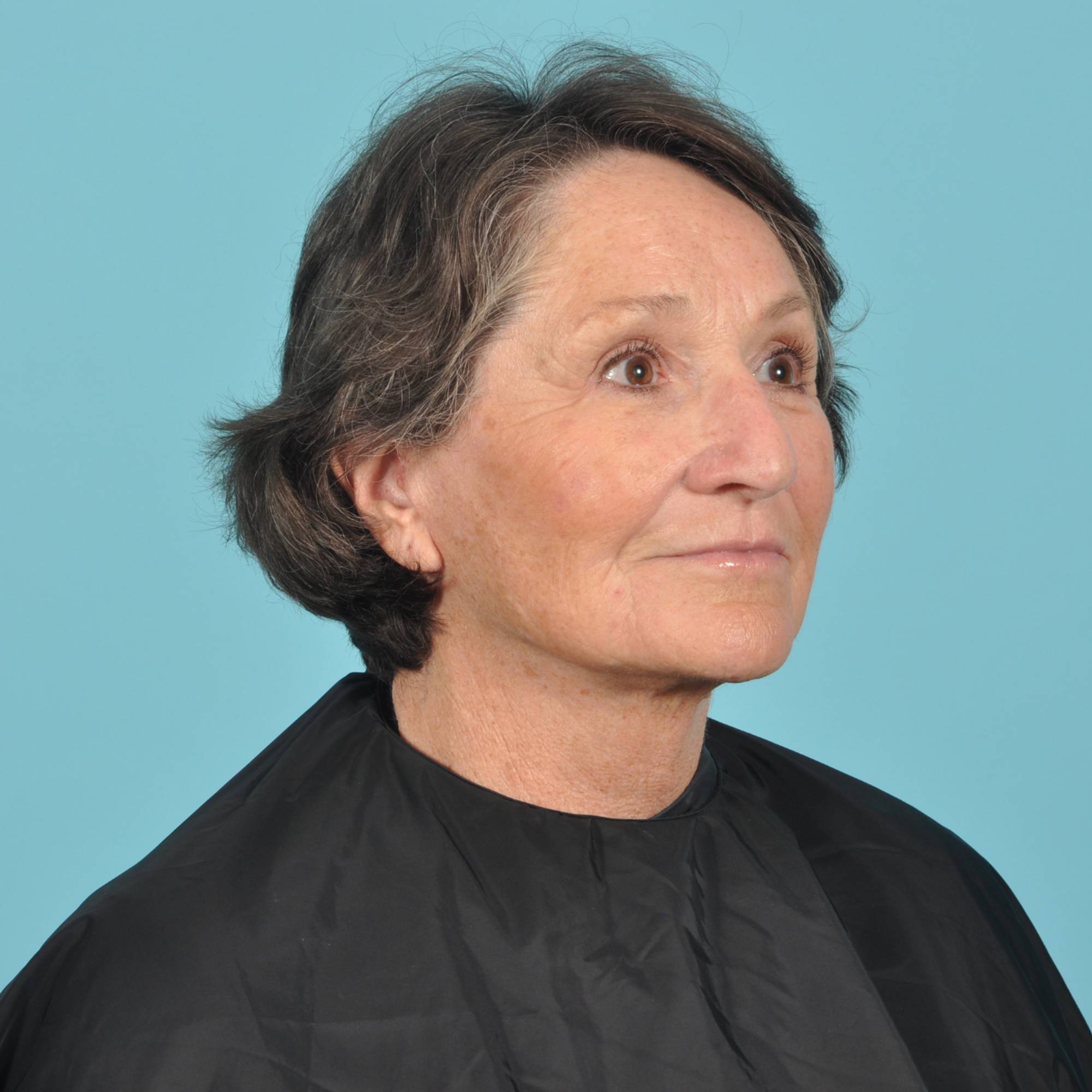 Facelift Before & After Image