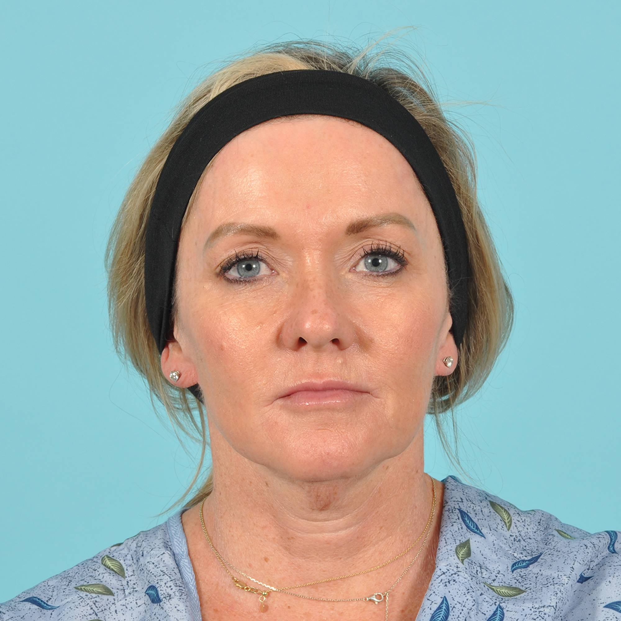 Facelift Before & After Image