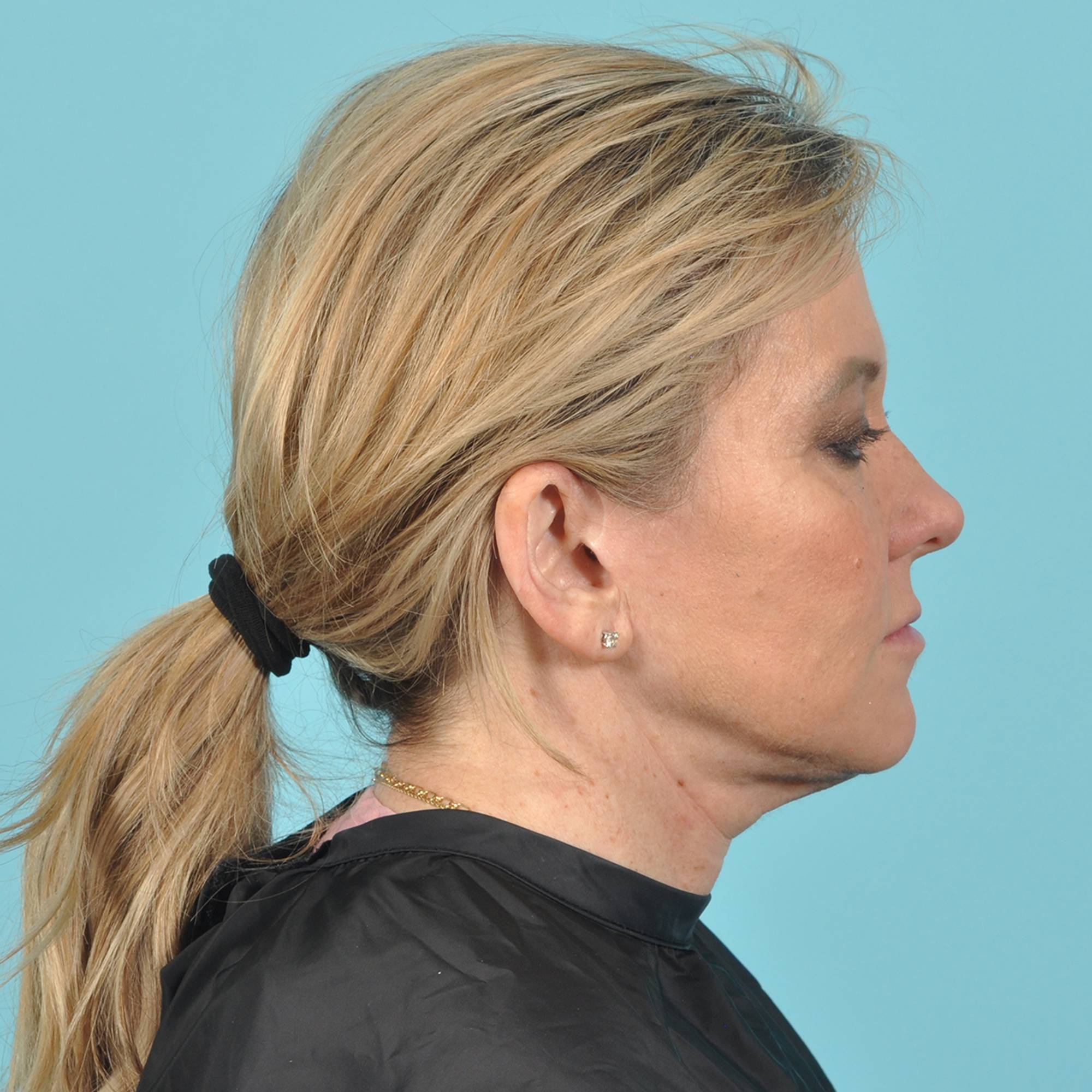 Facelift Before & After Image