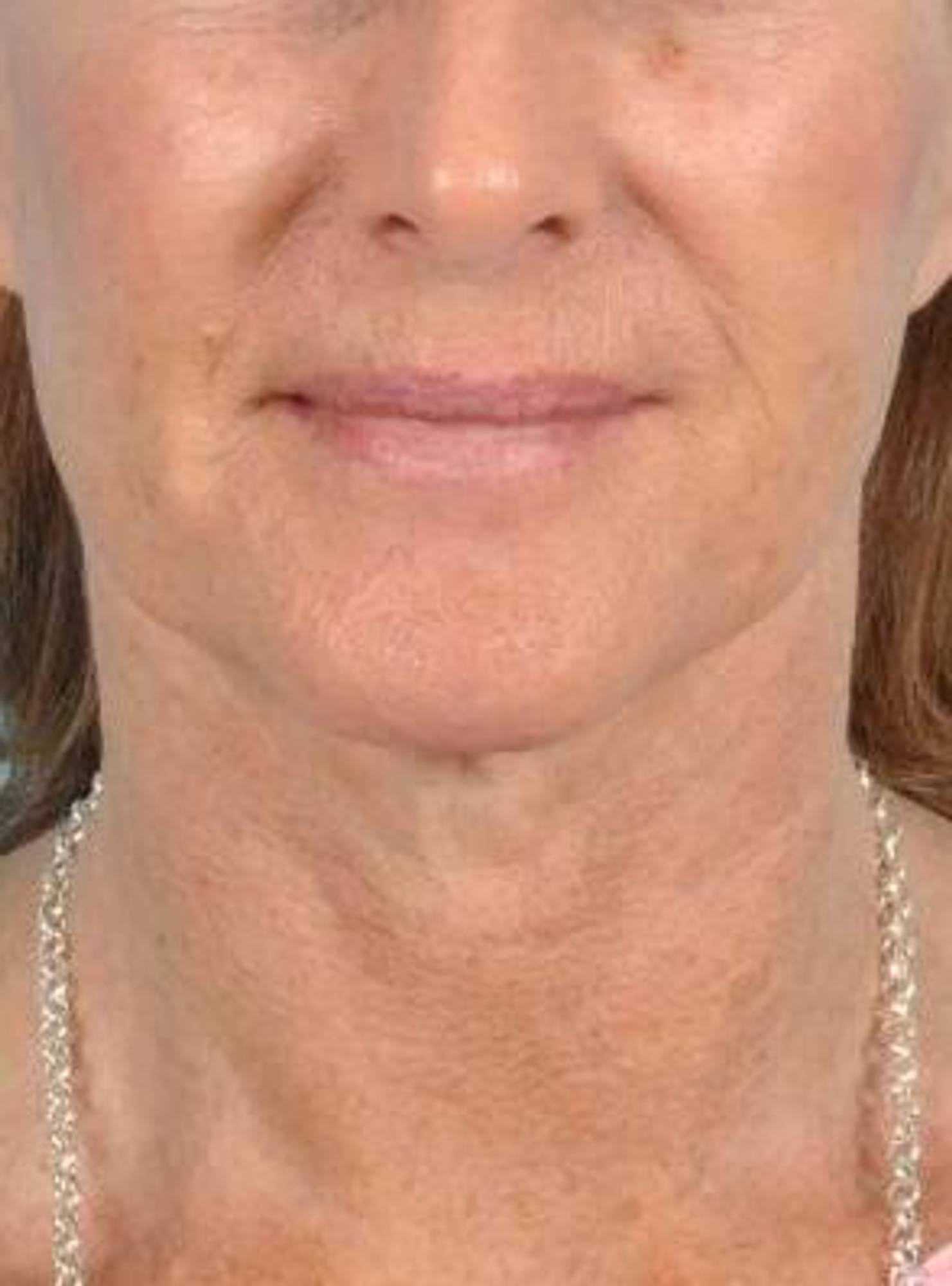 Facelift Before & After Image