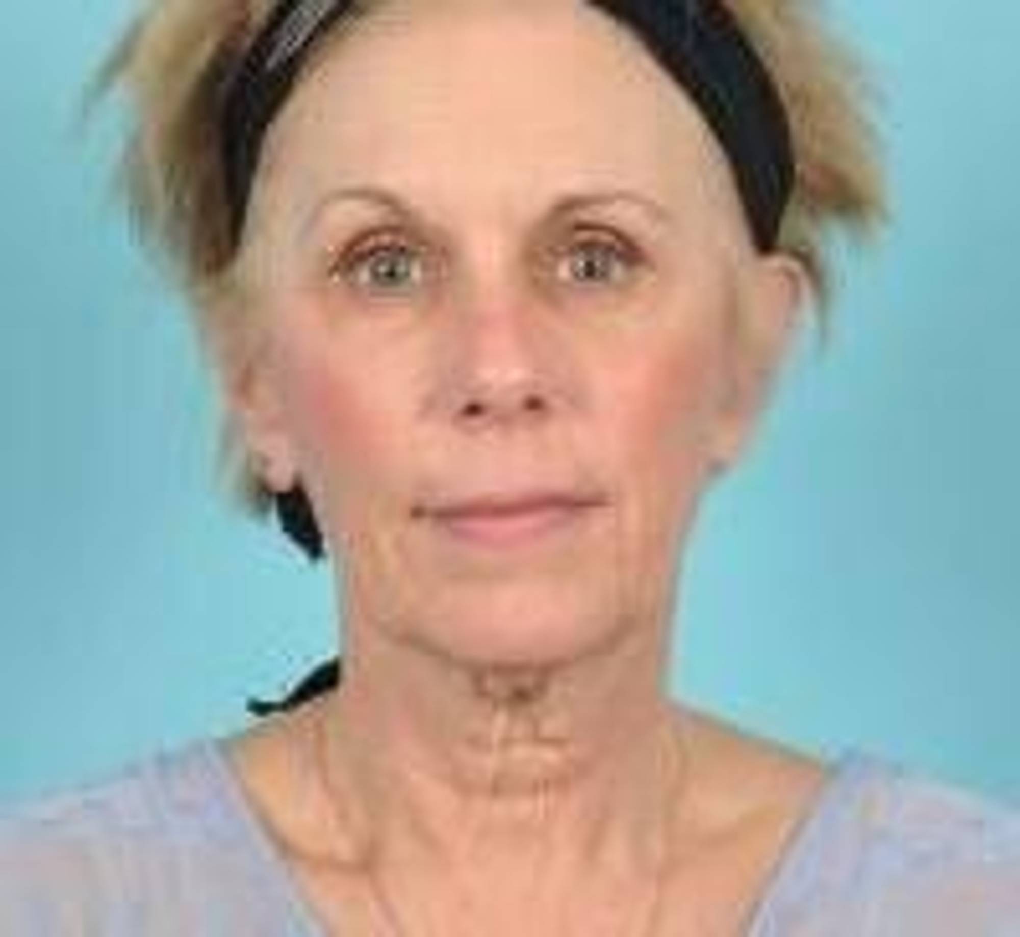 Facelift Before & After Image