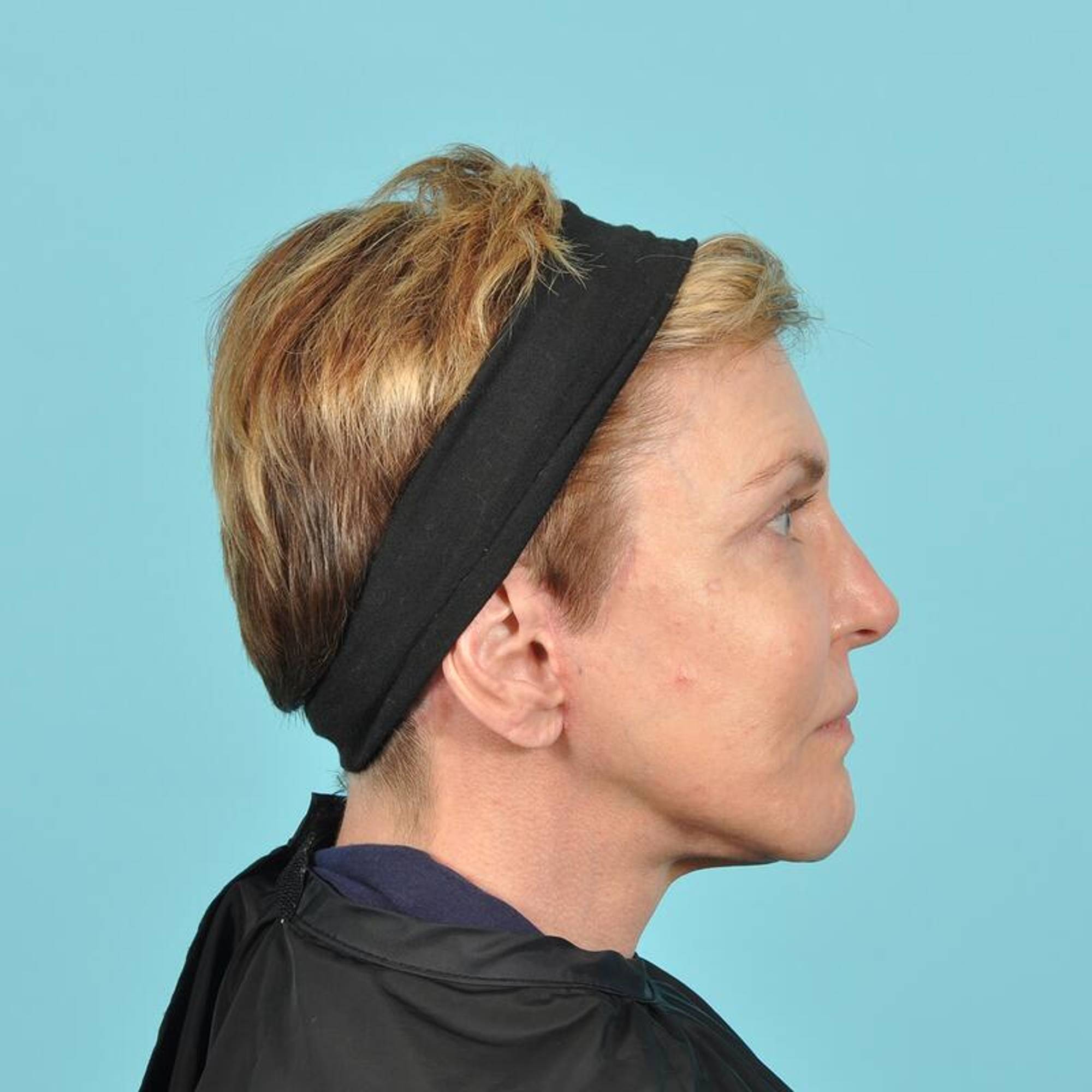 Facelift Before & After Image