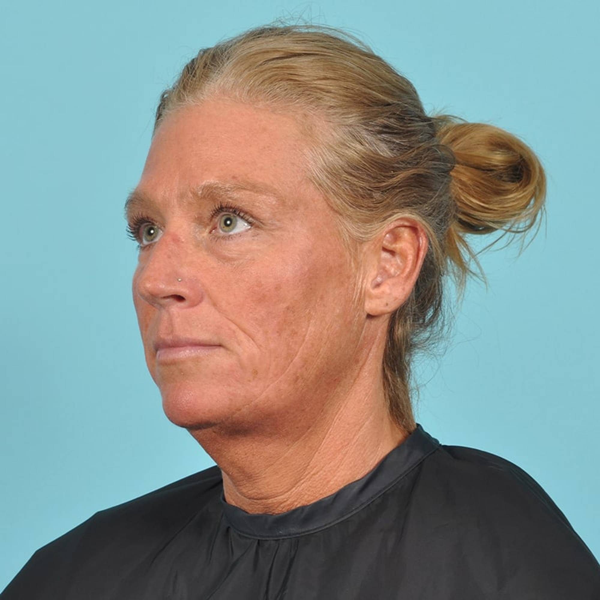 Facelift Before & After Image