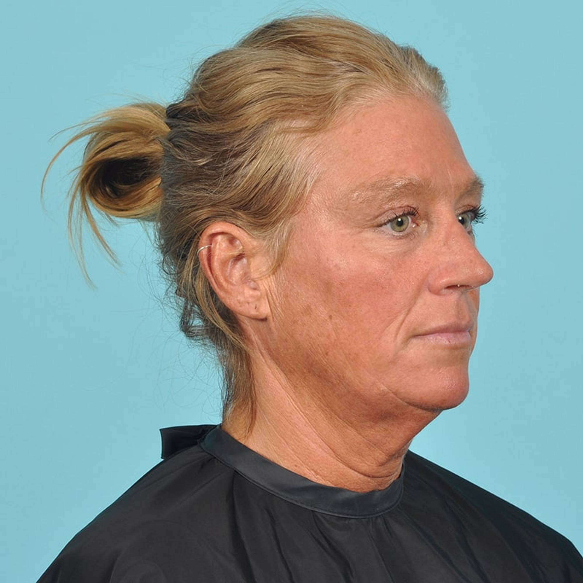  Before & After Image