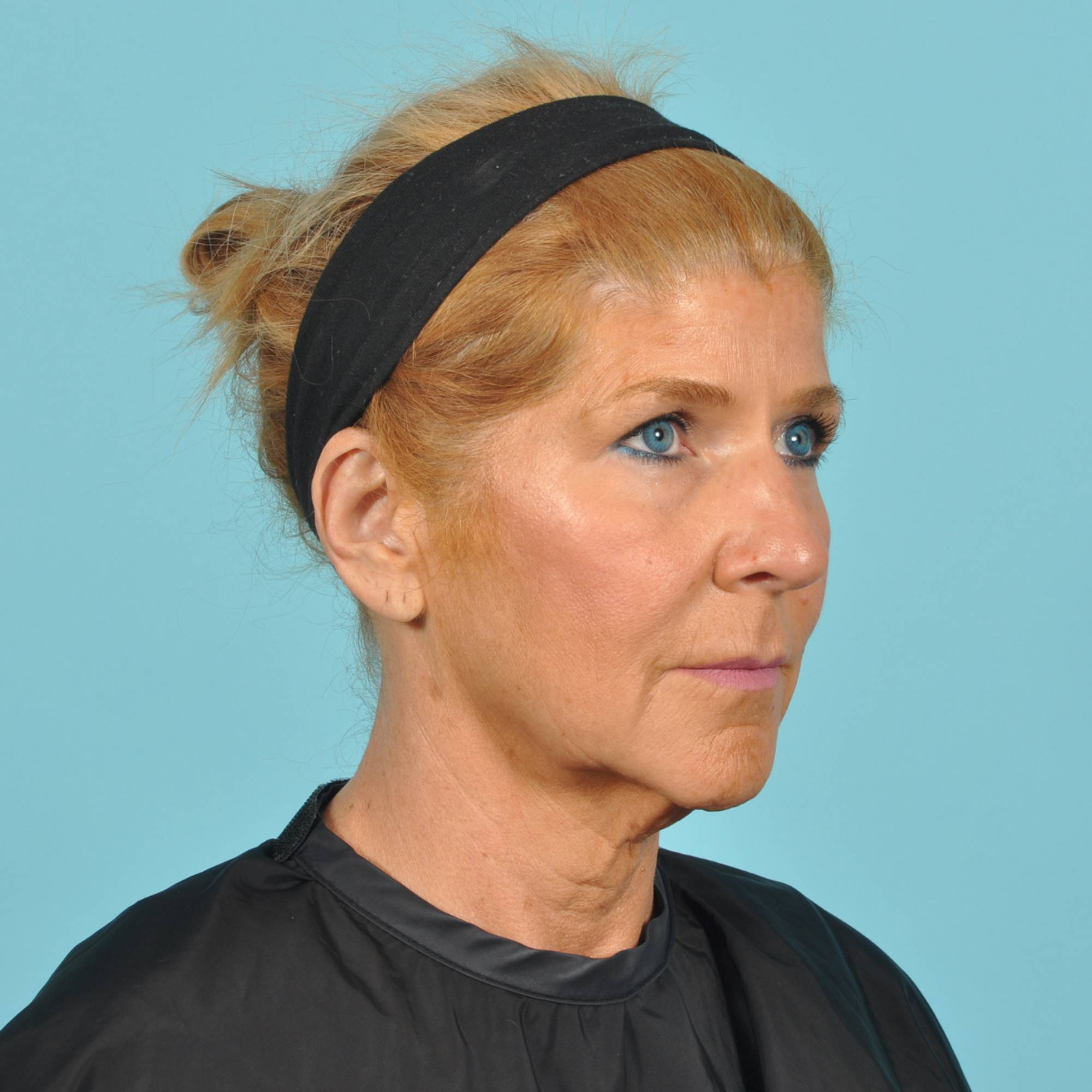 Facelift Before & After Image